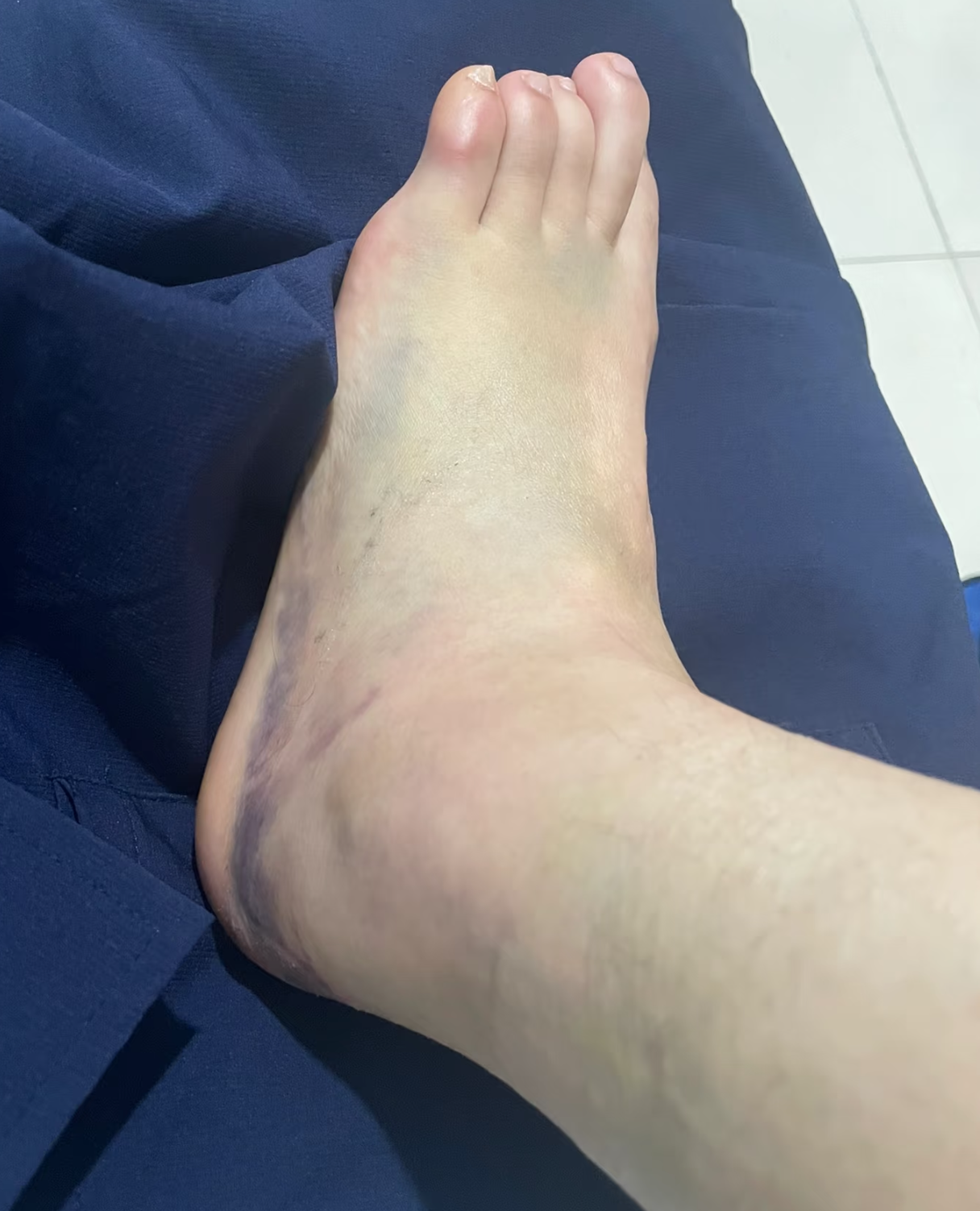 脚踝骨折75天后下地出现脚部发红发紫,这种情况需要重视
