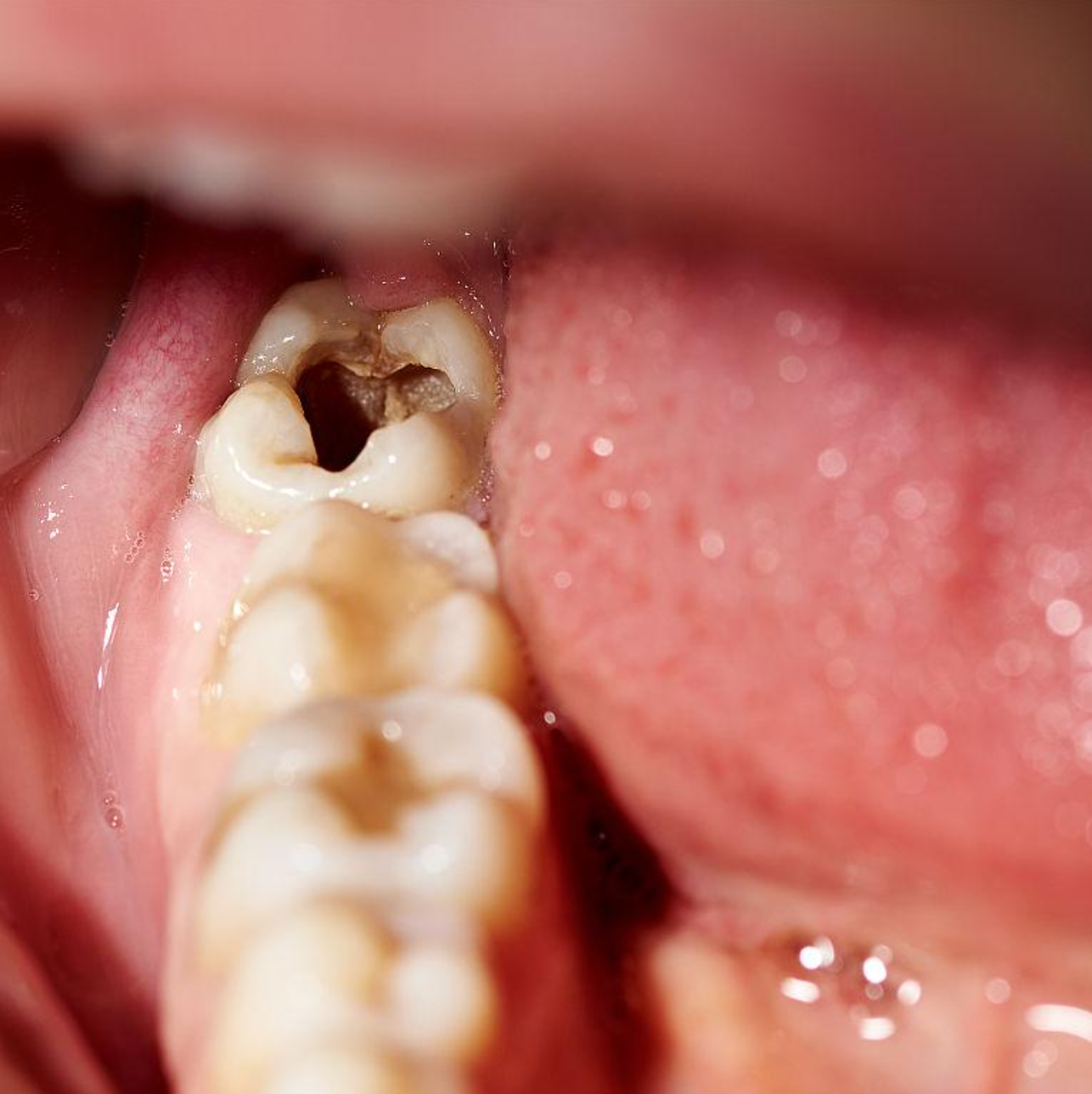 智齿是口腔最后面长出的牙齿,数量因人而异,一般是0