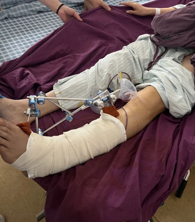 这时候可以用石膏固定骨折部位,防止它移动.不过大多