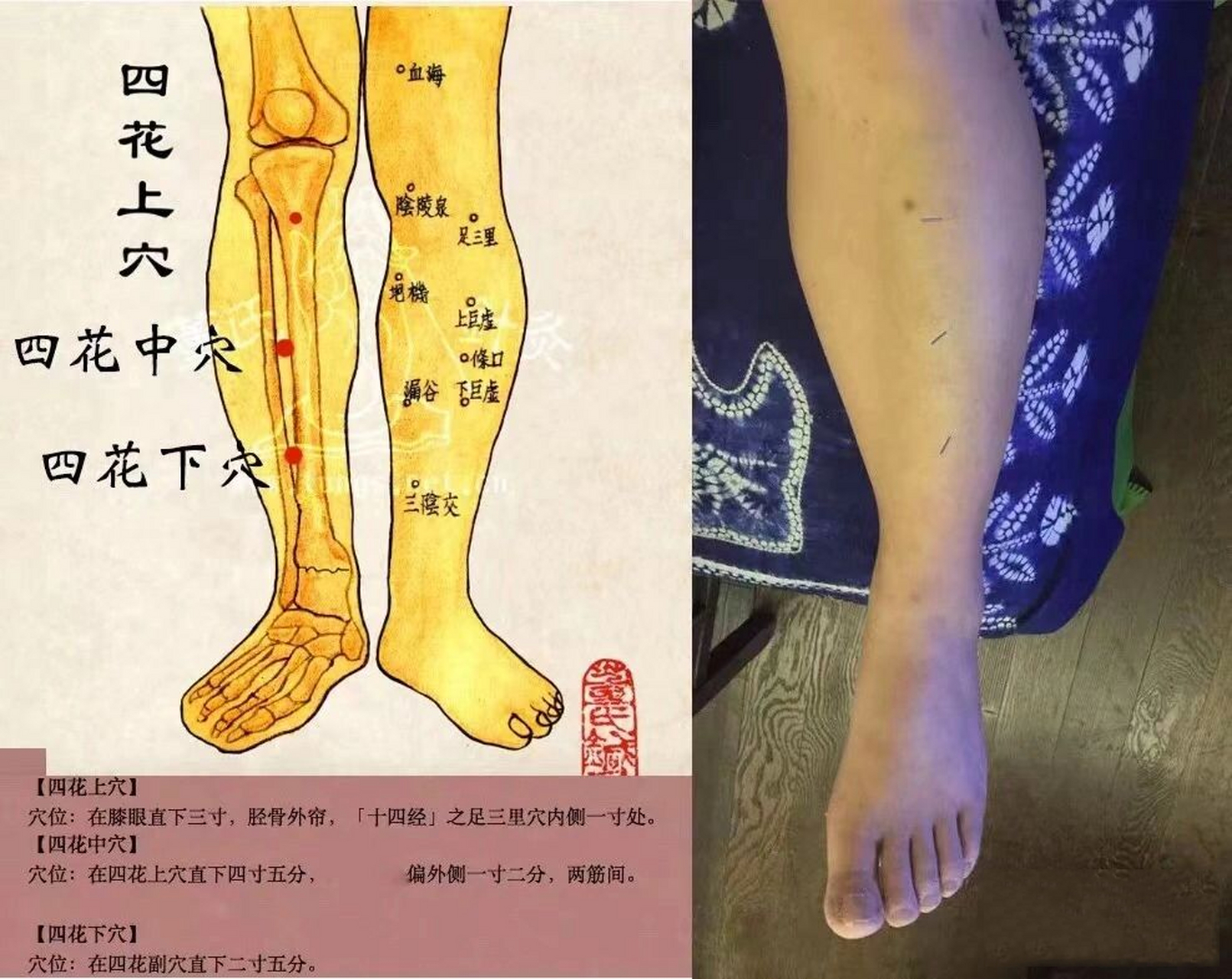 识穴第34篇|【四花穴】消化不良,哮喘,胃 【董氏针灸·四花穴】 消化