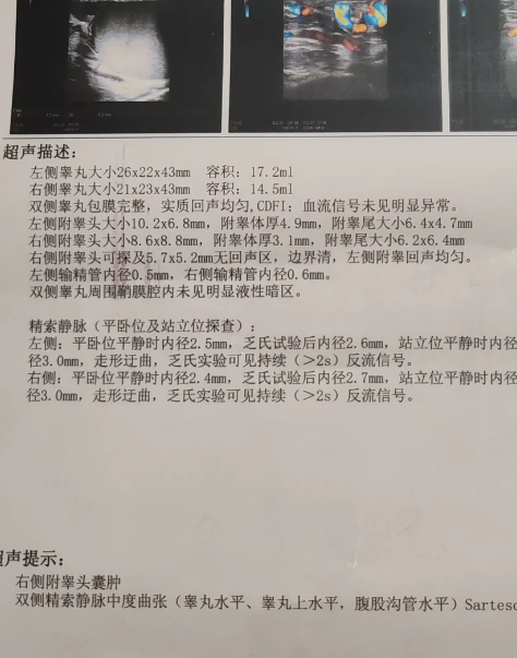 精索静脉曲张按超声检查结果分为三度:轻度,中度和重度.2