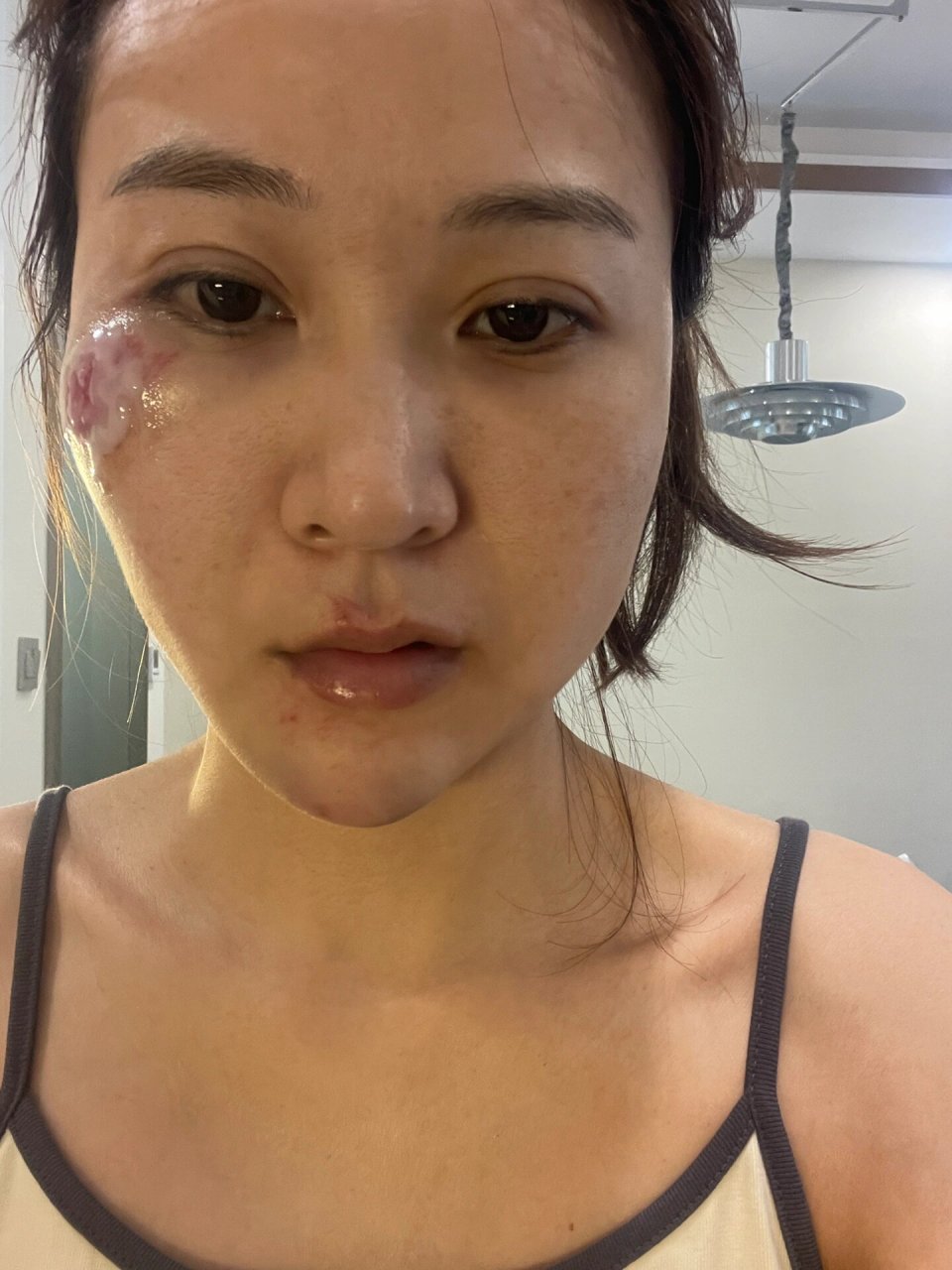 骑电动车摔伤了,脸上的皮擦破了,自己有点疤痕体质,涂了医院给开的