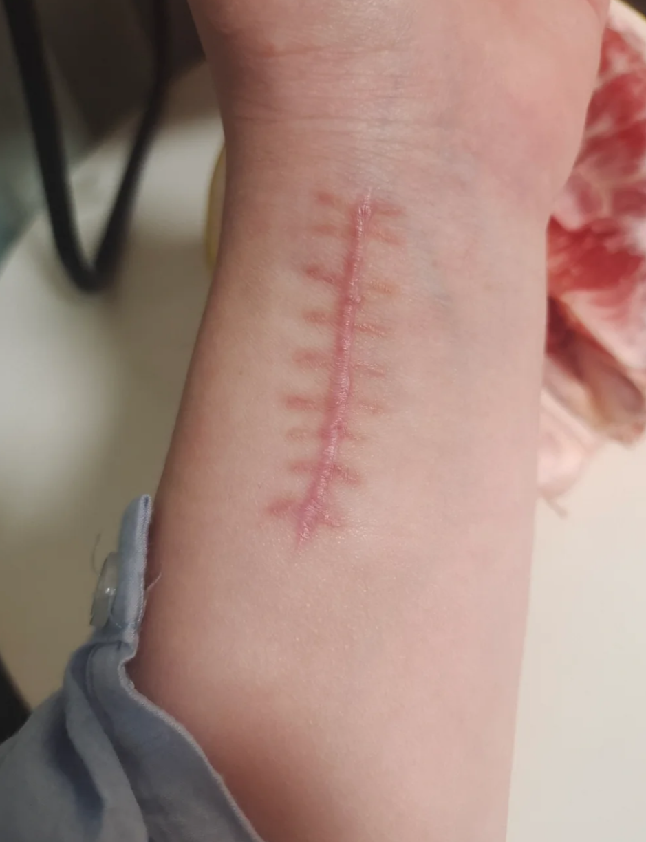 缝针后会不会留疤要看伤口的情况