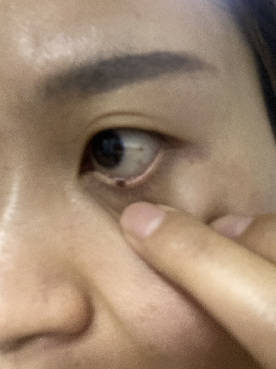 眼睑上长了一颗凸出的红痣,会不会有危险