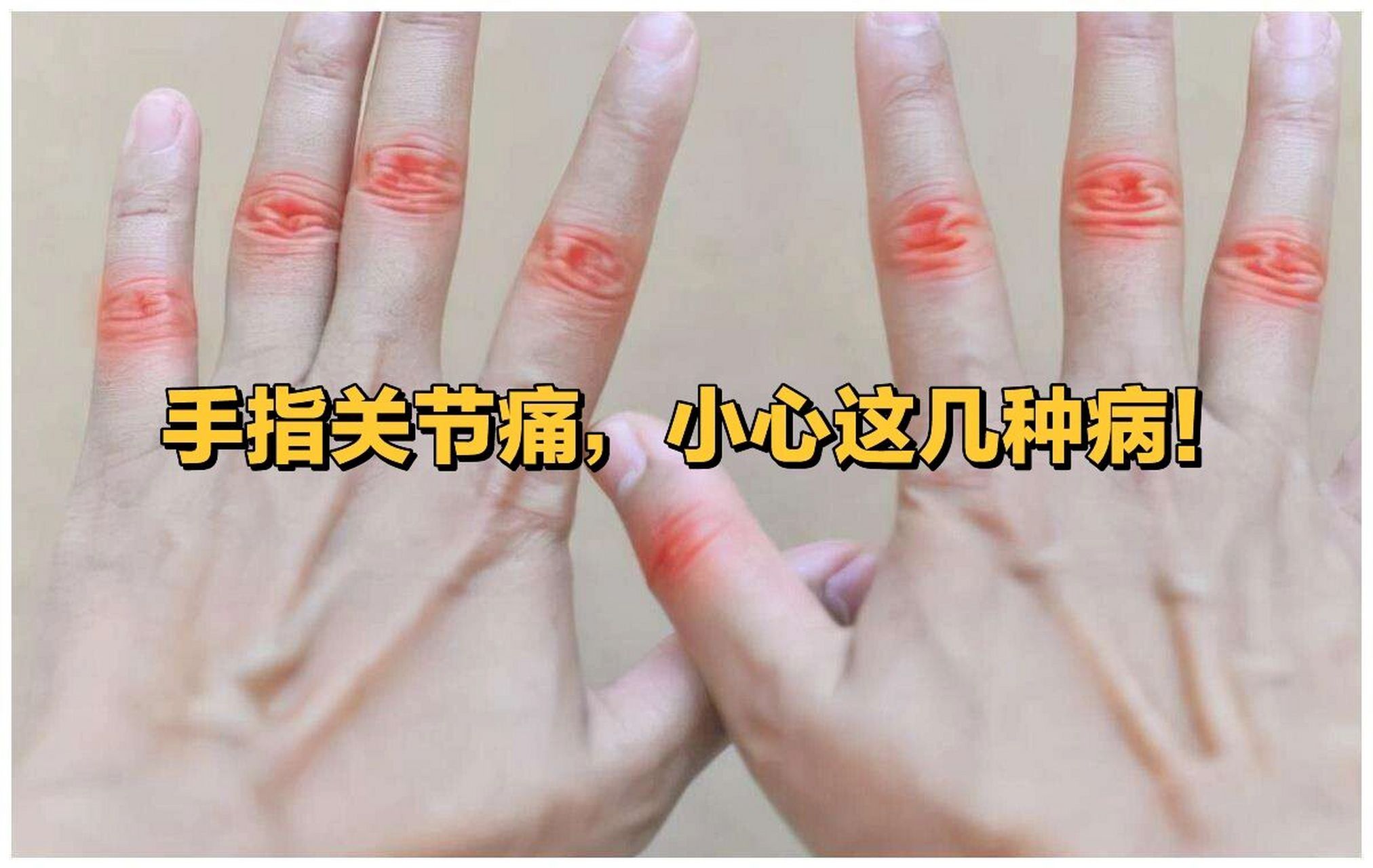 第一,骨性关节炎,就是关节疼痛的最常见原因,经常出现手指关节肿痛的