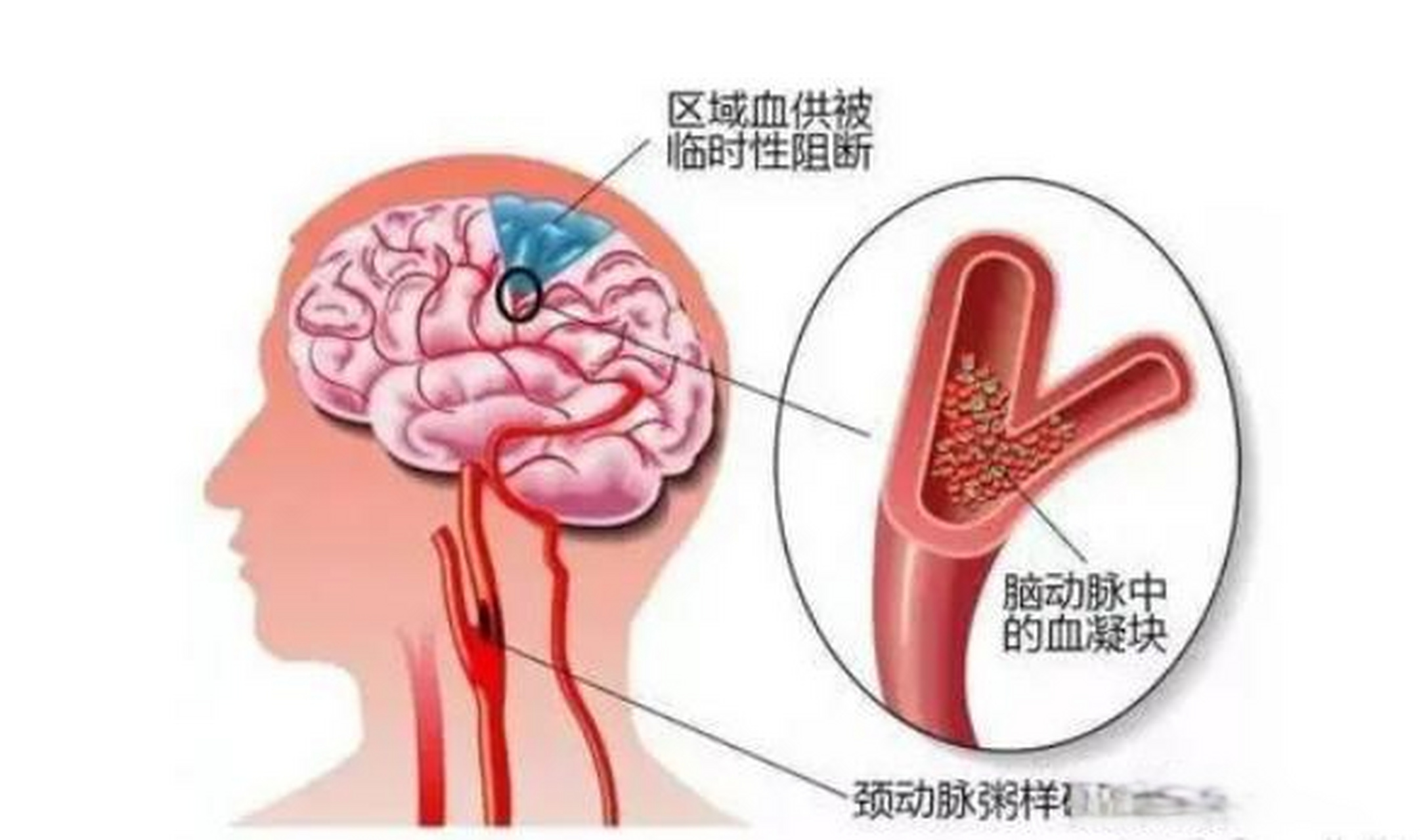 脑梗塞病因图片图片