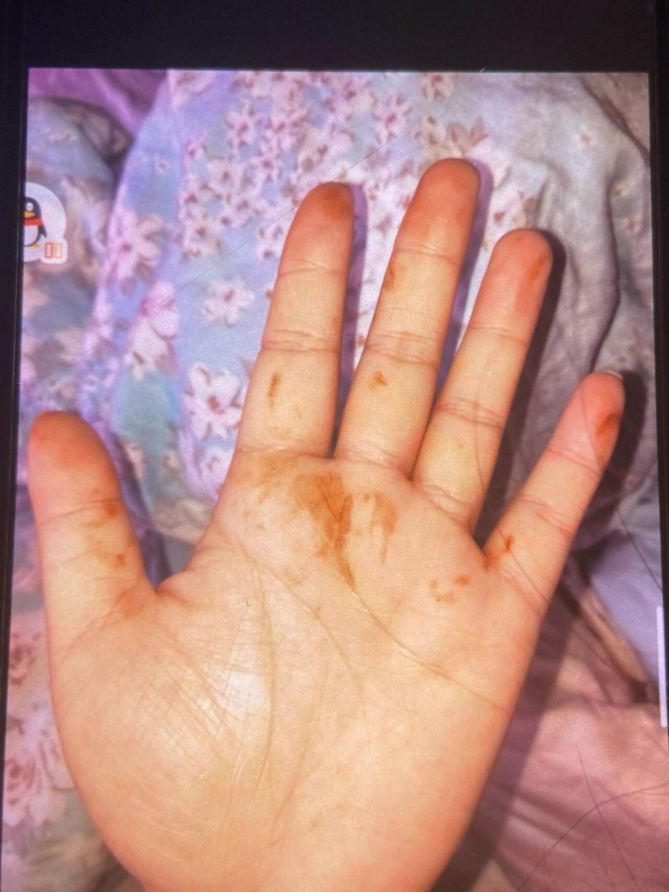 手上出现铁锈色的东西 一觉睡醒,手上出现铁锈色的东西,不是蹭上去的