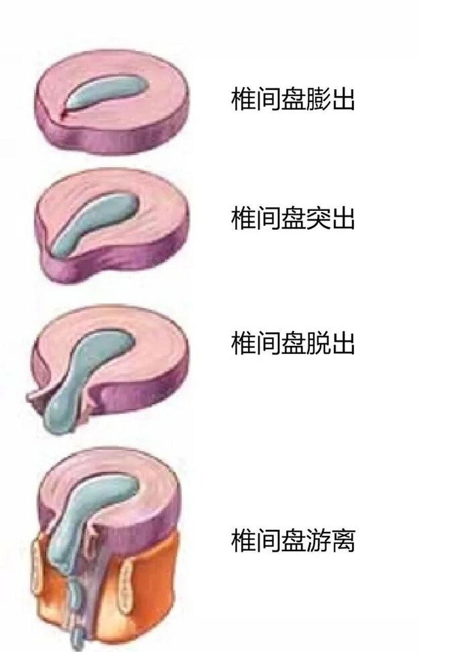 腰椎间盘突出症(1) 腰椎间盘突出症分型:膨出,突出,脱出,游离(图1