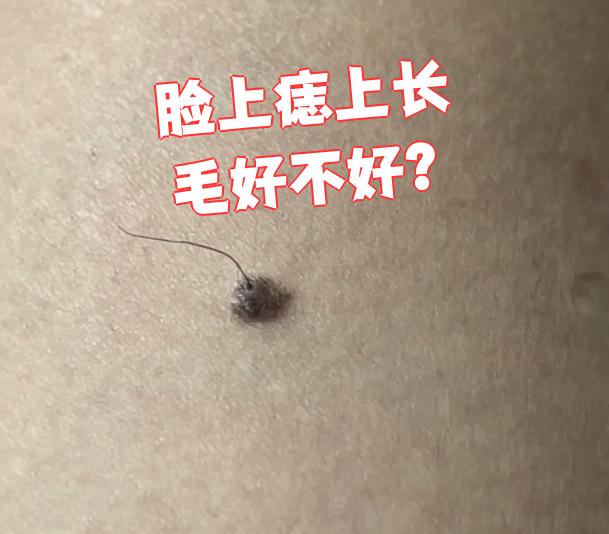 脸上痣上长毛好不好?