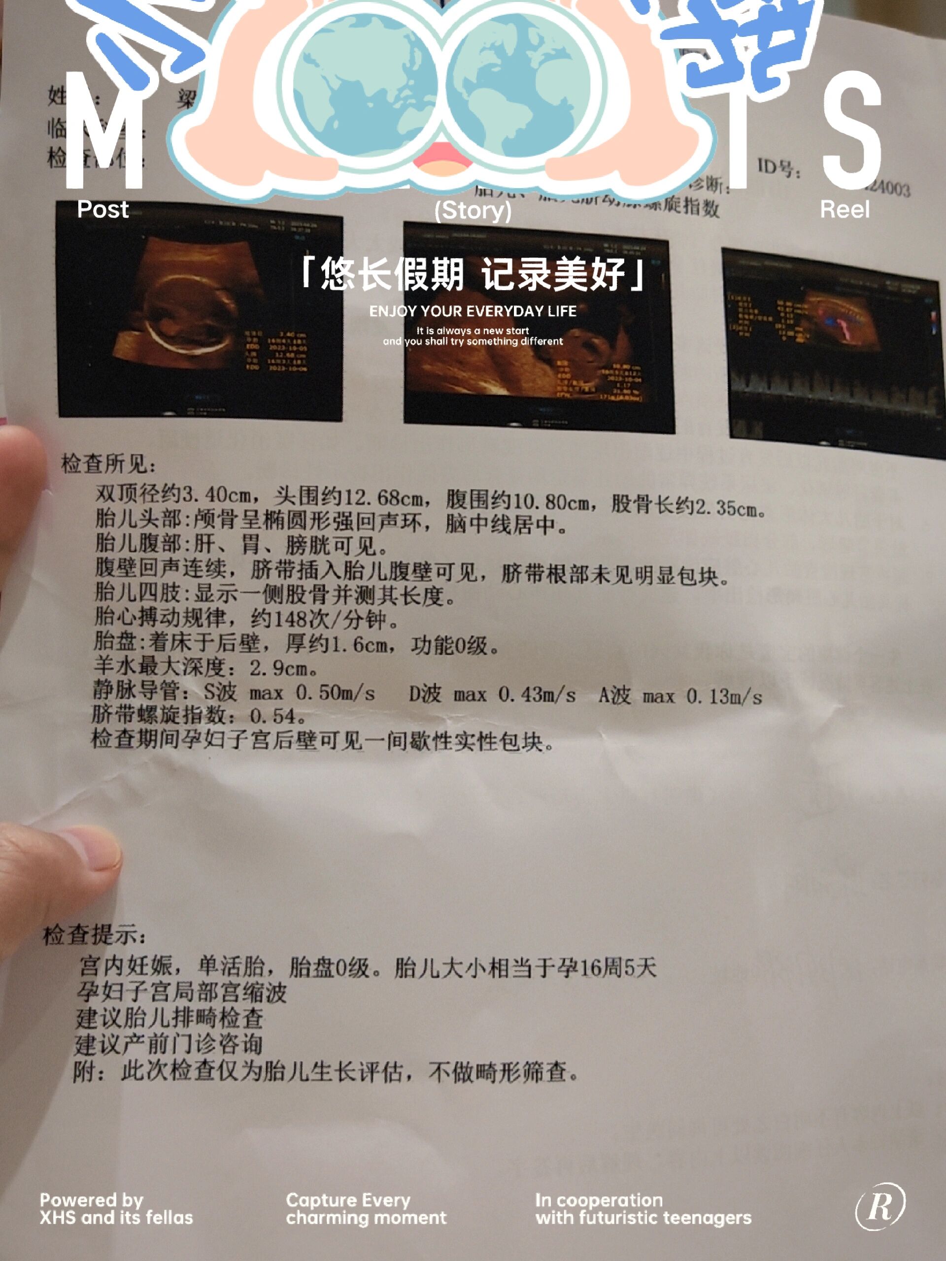 孕16周 脐带螺旋指数高继续保胎中 关关难过关关过,熬过了孕早期的