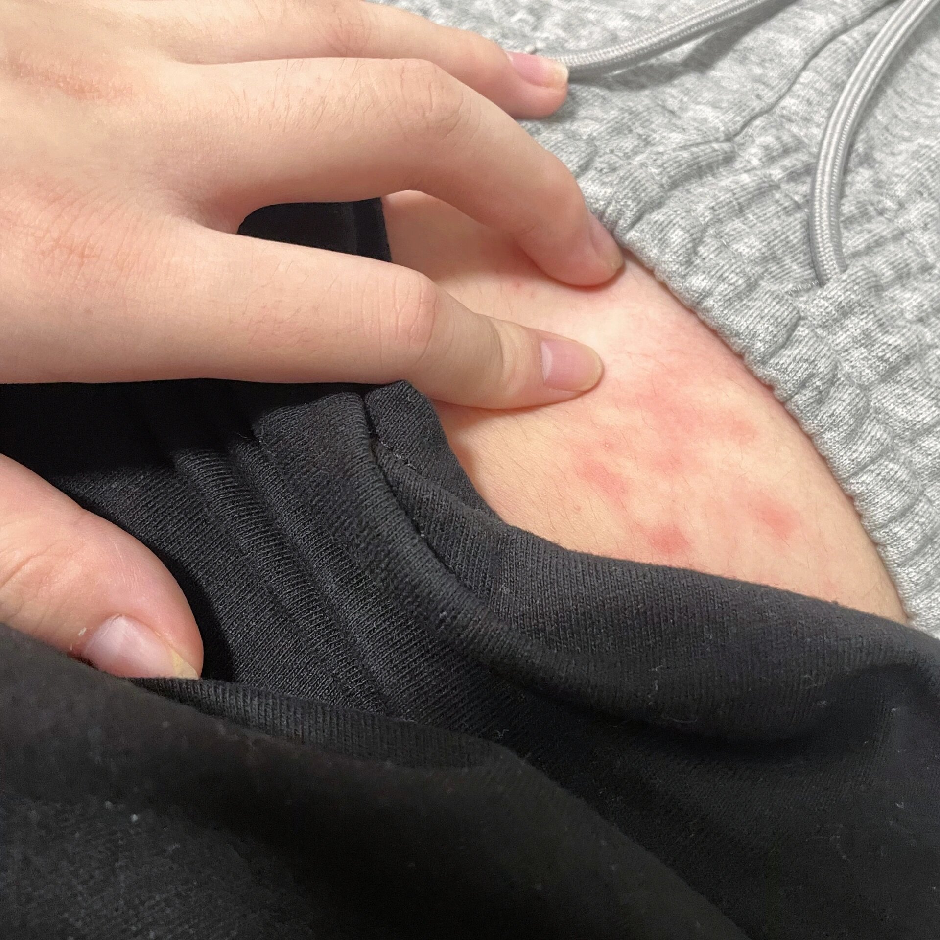 不会有人会用暖宝宝把自己烫伤吧