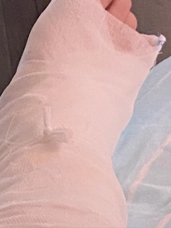 骨折第六天 外面绷带感觉松松垮垮石膏也小部分移动了 绑着石膏真的不