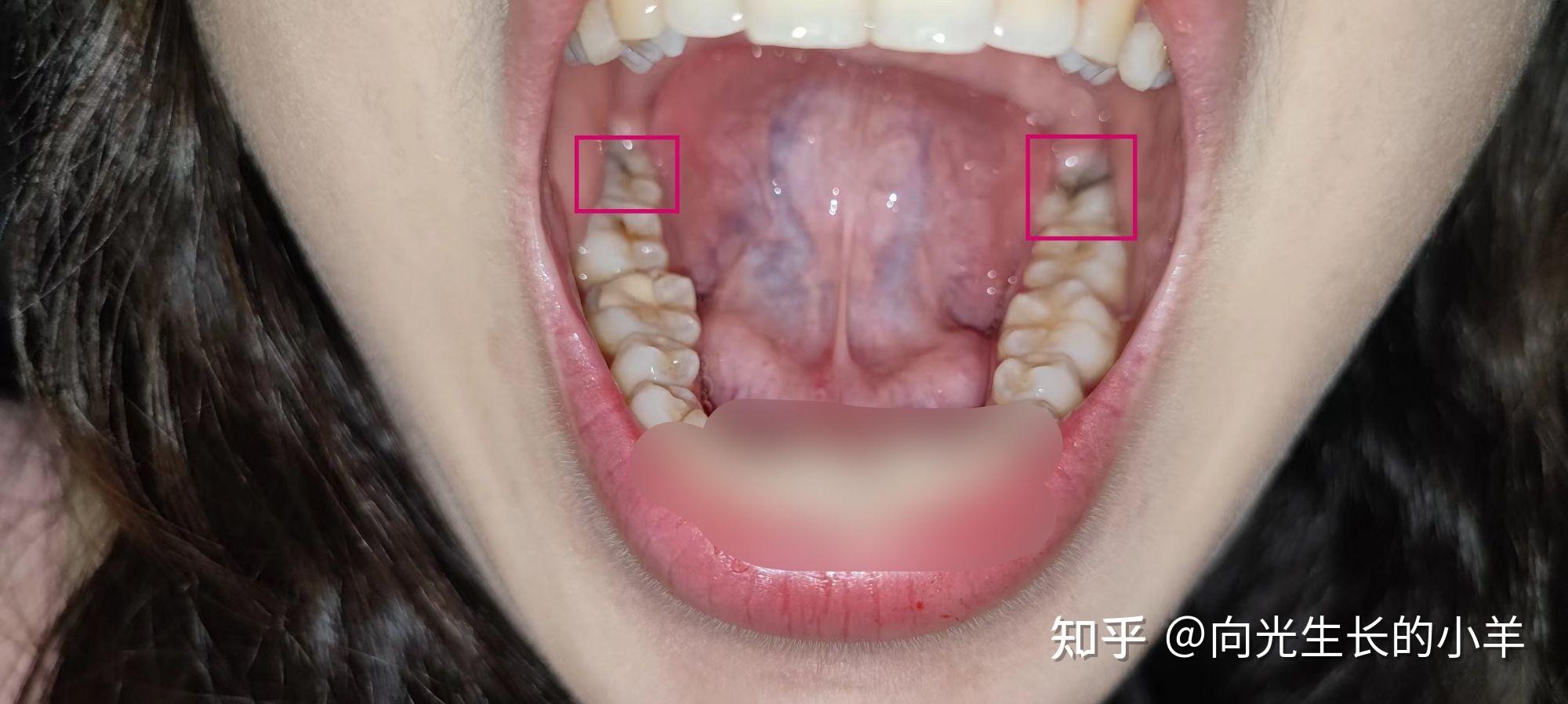 拔尽头牙过程图片