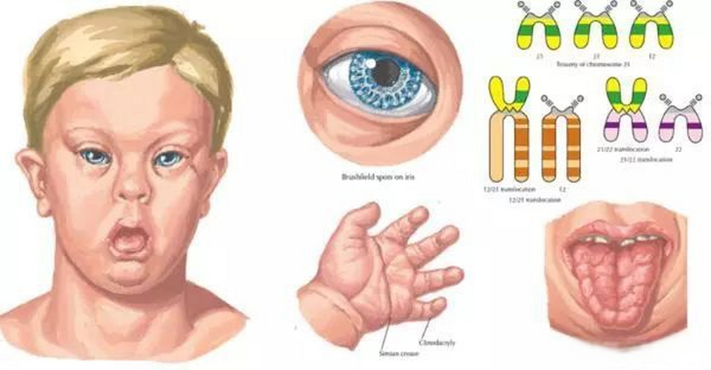 13三体综合征患者图片