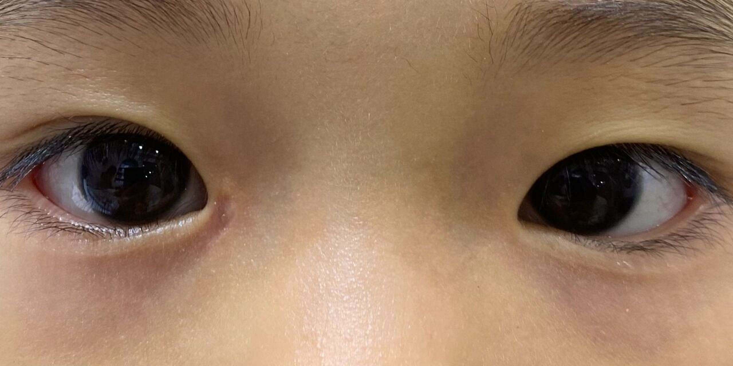 泪囊瘘手术 泪囊瘘术后3个月啦 我们没有护理得很好,经历了多次发炎