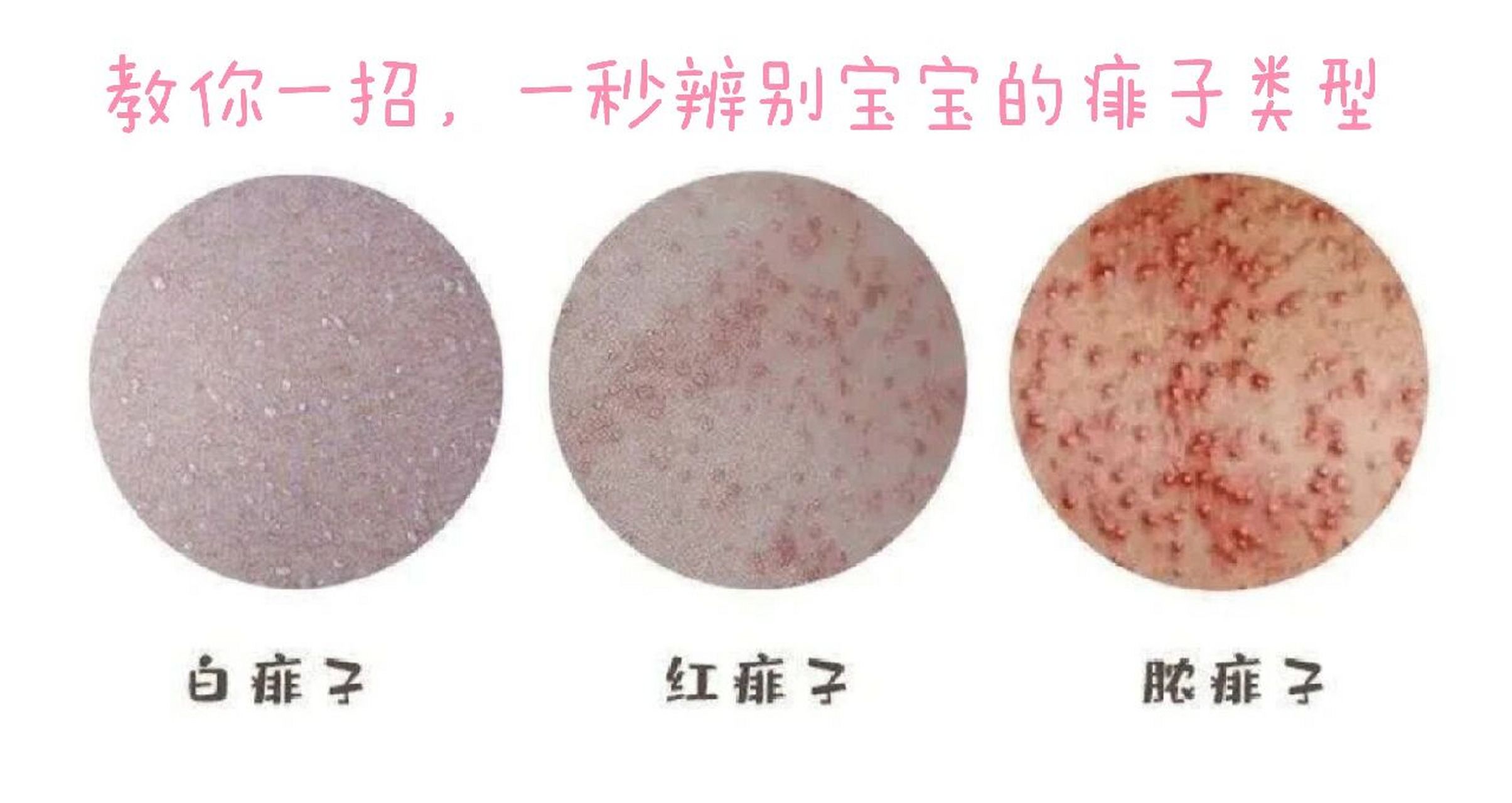 其实,痱子从种类上说可分3种:红痱,白痱和脓痱.  白痱(晶形粟粒疹) .