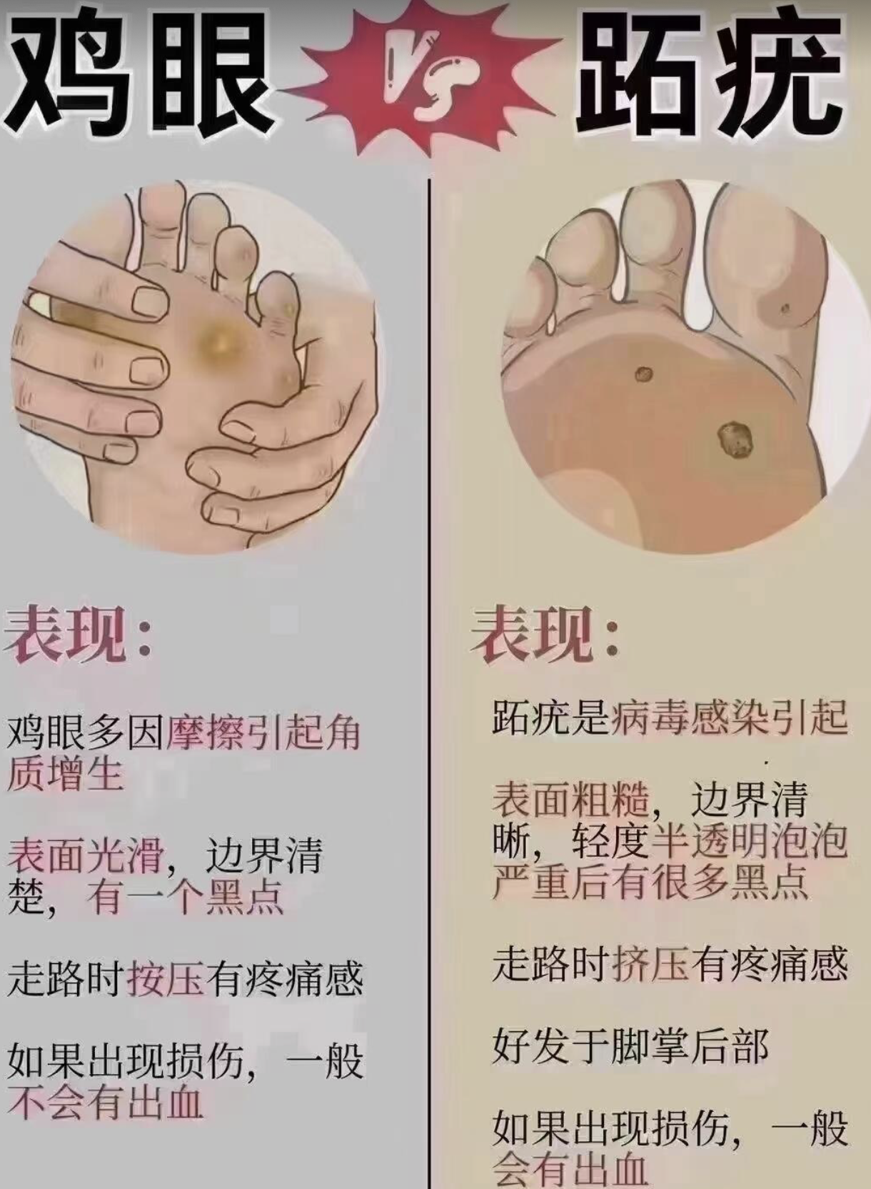 鸡眼可以长在手上