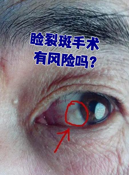 睑裂斑手术确实存在一定风险