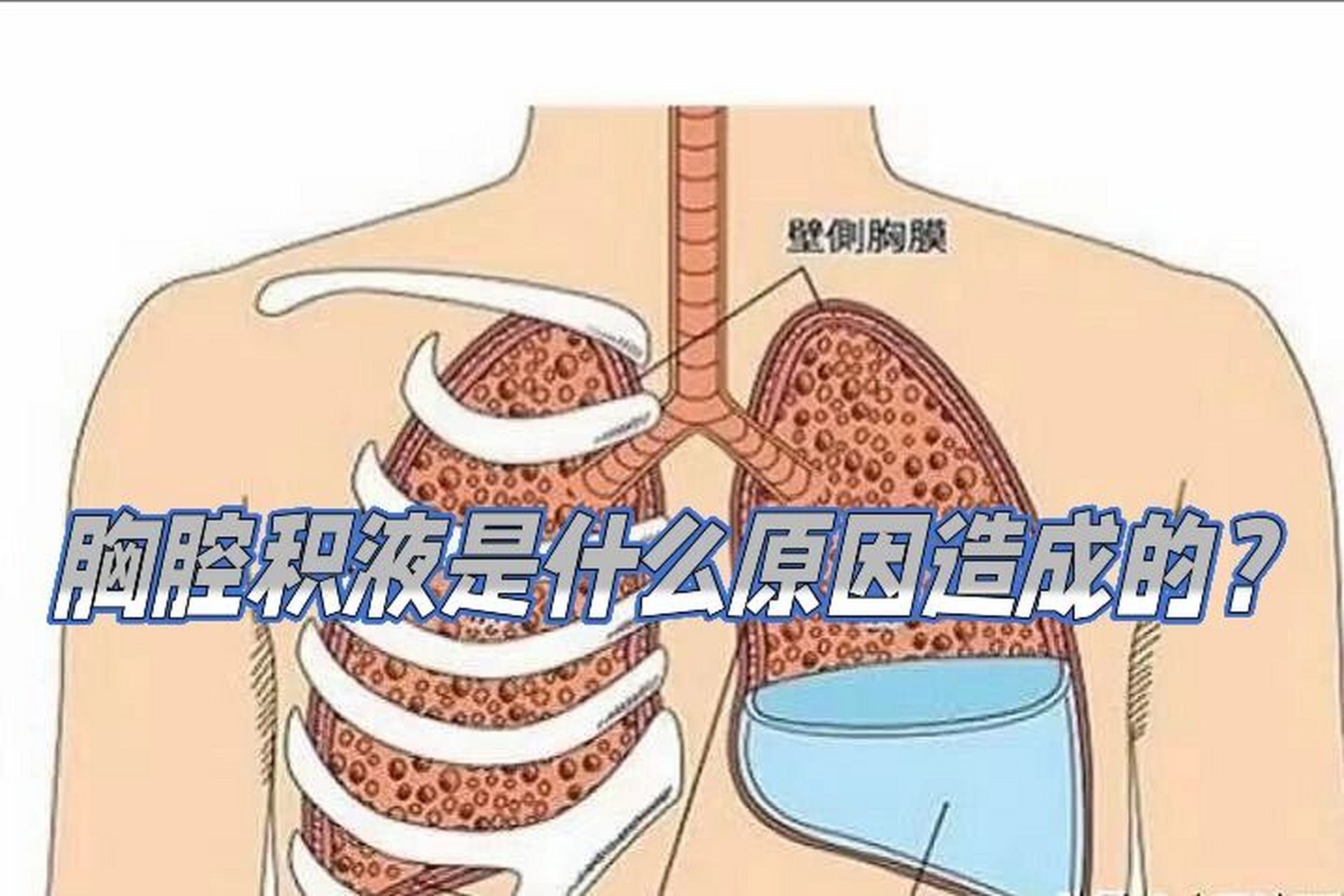 胸腔积液可能是由于胸膜炎,肺部肿瘤等原因造成的