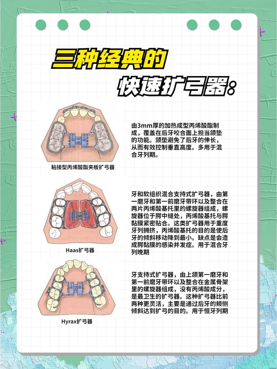 牙齿矫正扩弓器,种类71优缺71 对于上颌骨狭窄