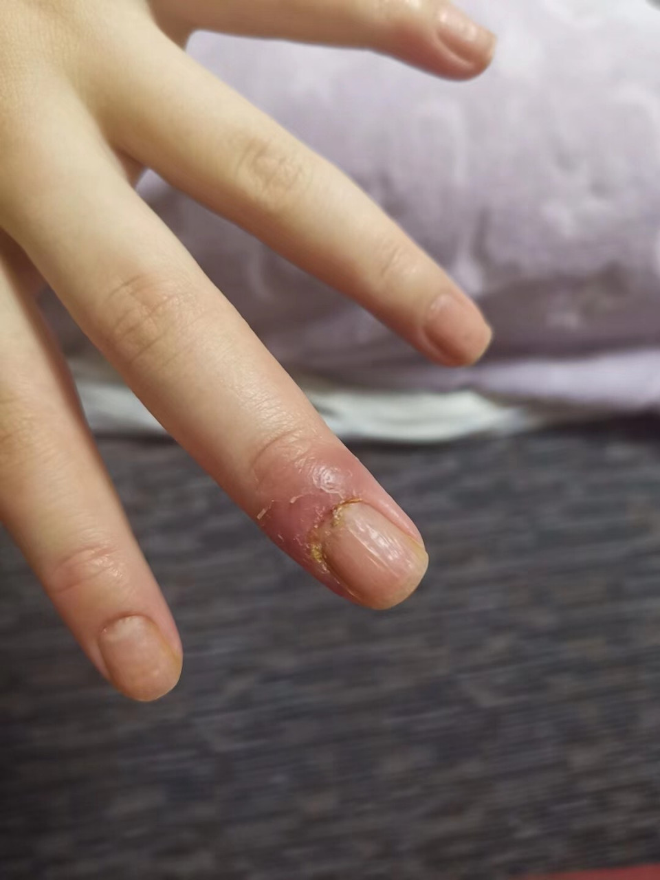 湿疹(汗疱疹 角质剥脱症)一个月的恢复情况～完美 指甲是因为之前发