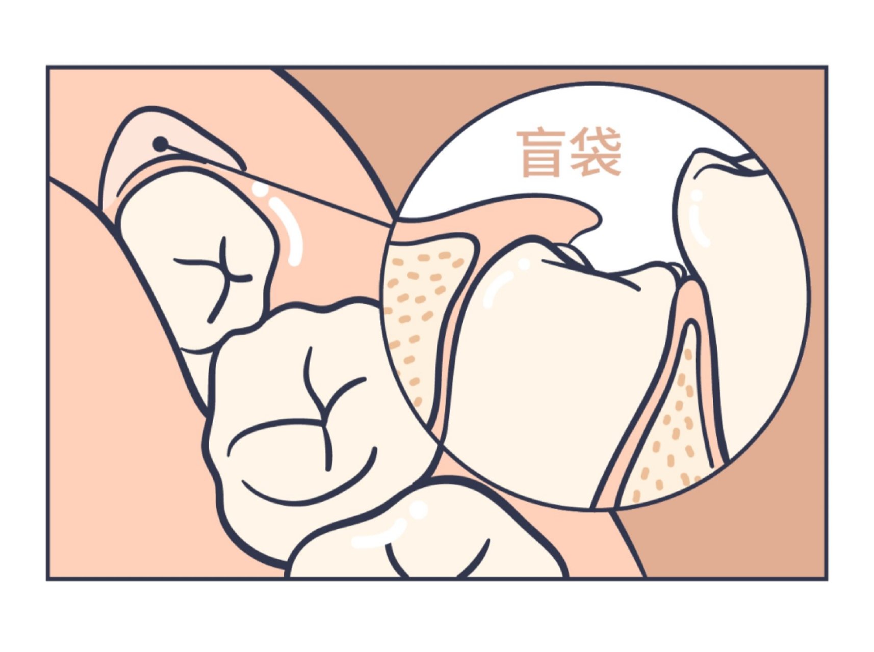 智齿盲袋发炎且 不想拔牙的姐妹!