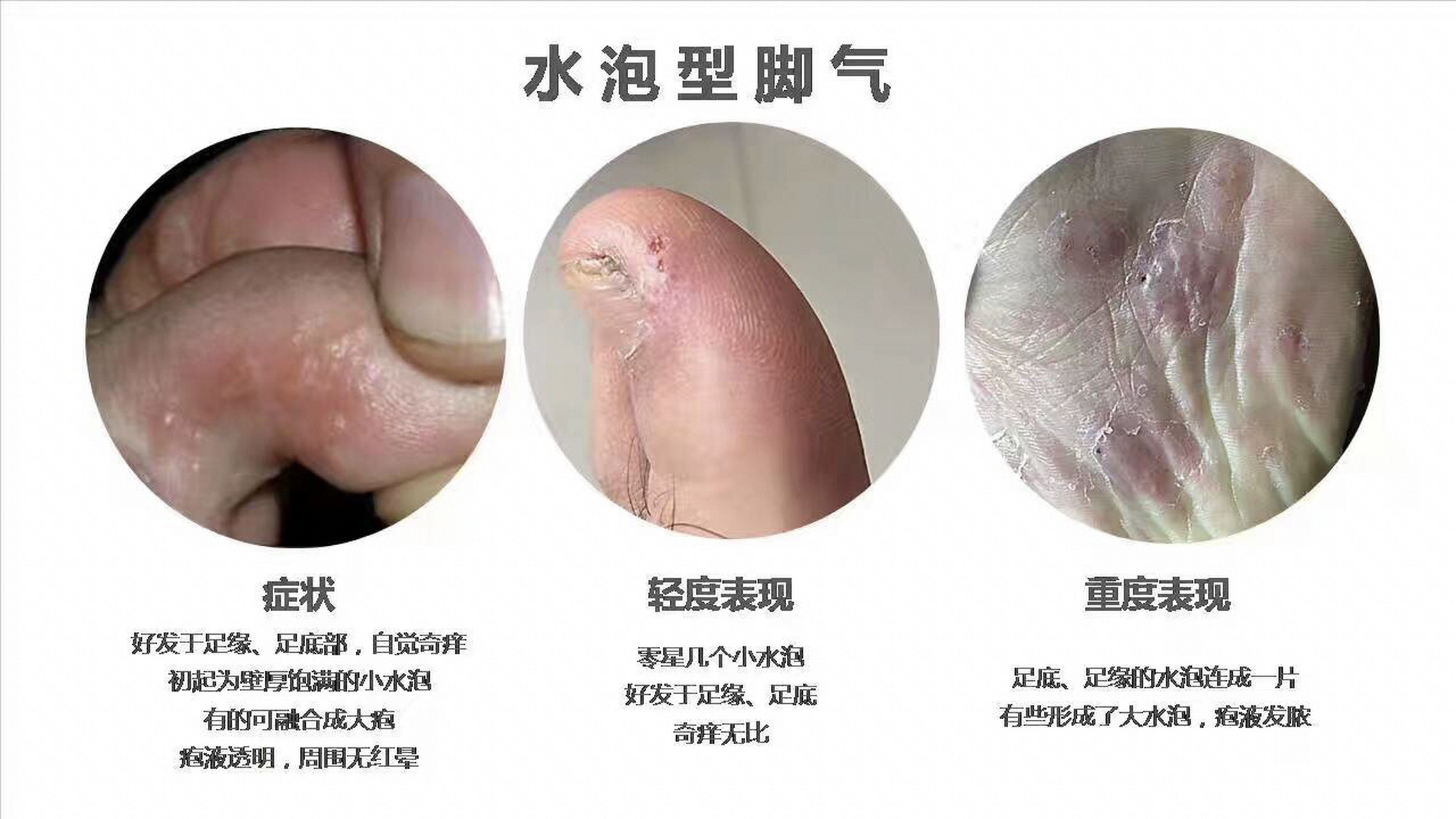 水泡型脚气好发于足缘,足底部,多发生在夏季.