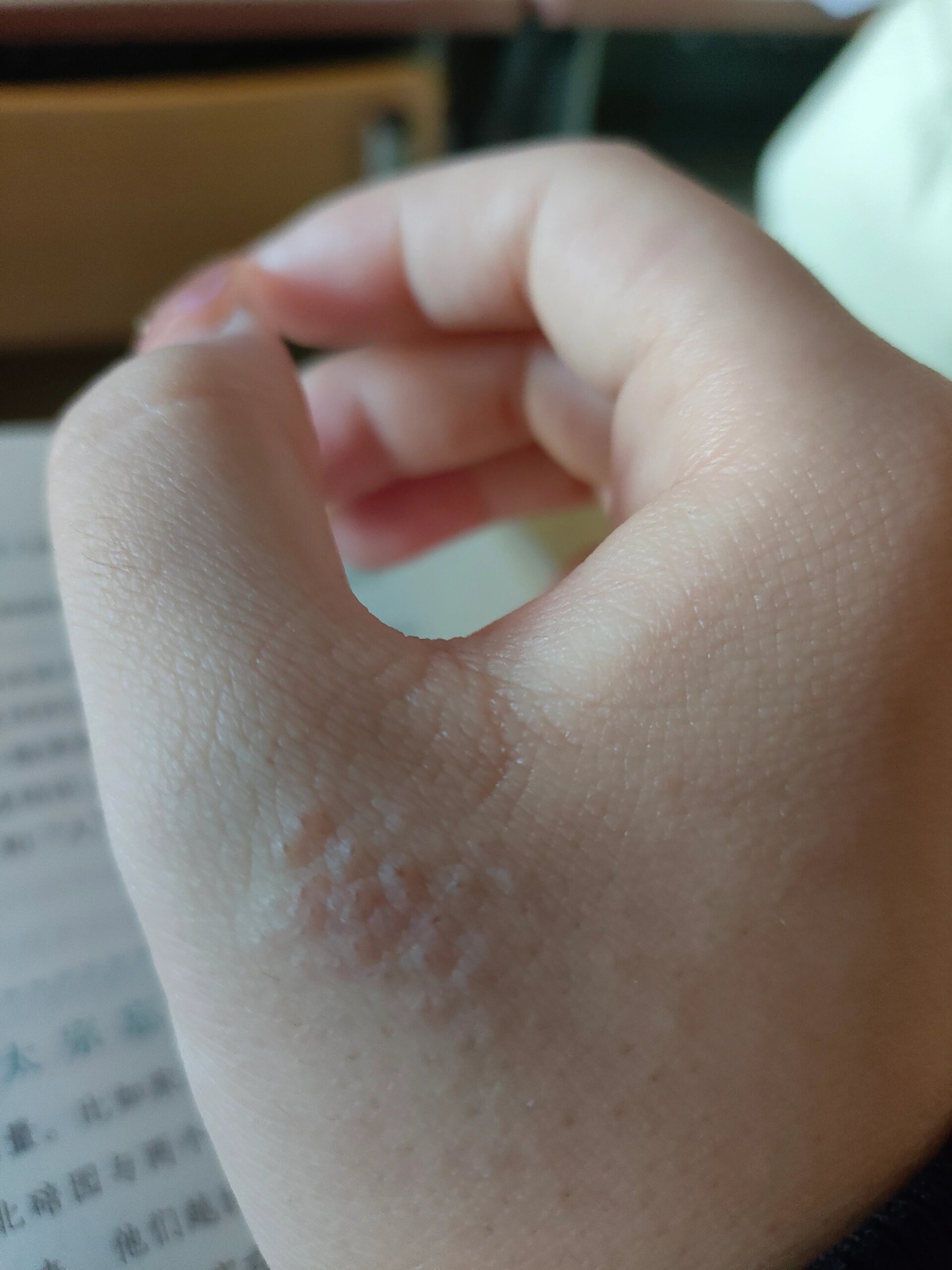 想问一下家人们,这到底是什么疙瘩,为什么我的手一到这个时候天气一冷