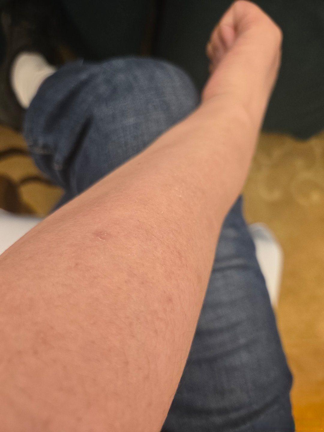 我这种紫外线过敏的人,做不好防晒,还在太阳底下溜达,晚上出现皮疹