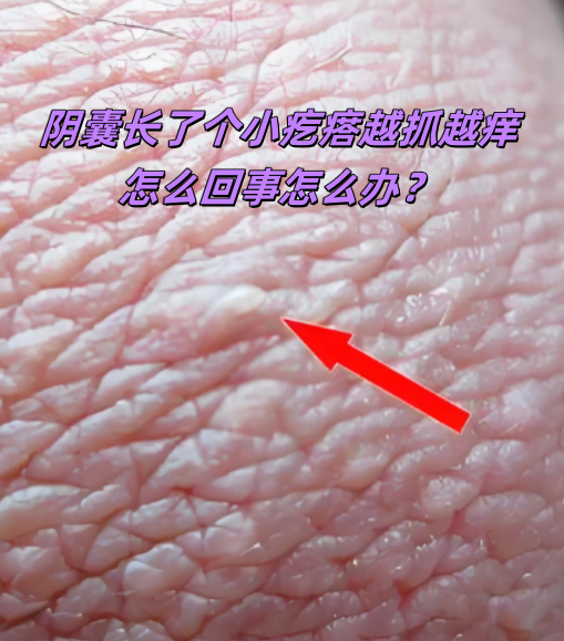 阴囊长了个小疙瘩而且越抓越痒,这种情况常见的原因有阴囊湿疹,挨皮