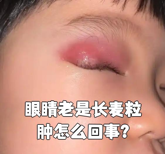 老是长麦粒肿主要和免疫力差,用眼不卫生,身体虚弱有关
