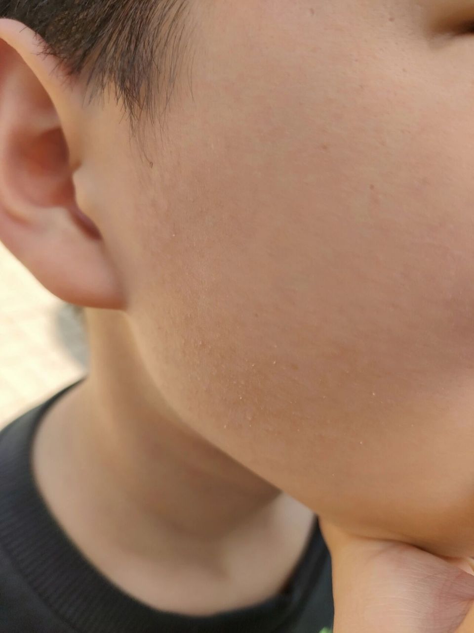 孩子脸颊两边很多小疙瘩 摸起来还有点扎手