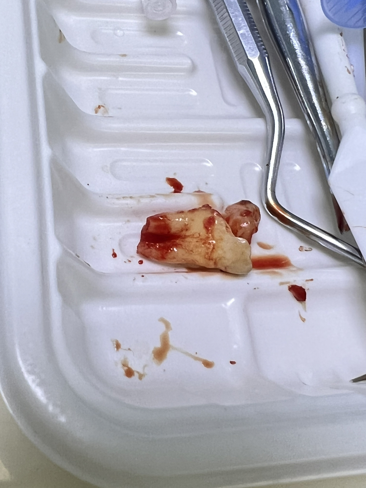 拔智齿横向阻生牙