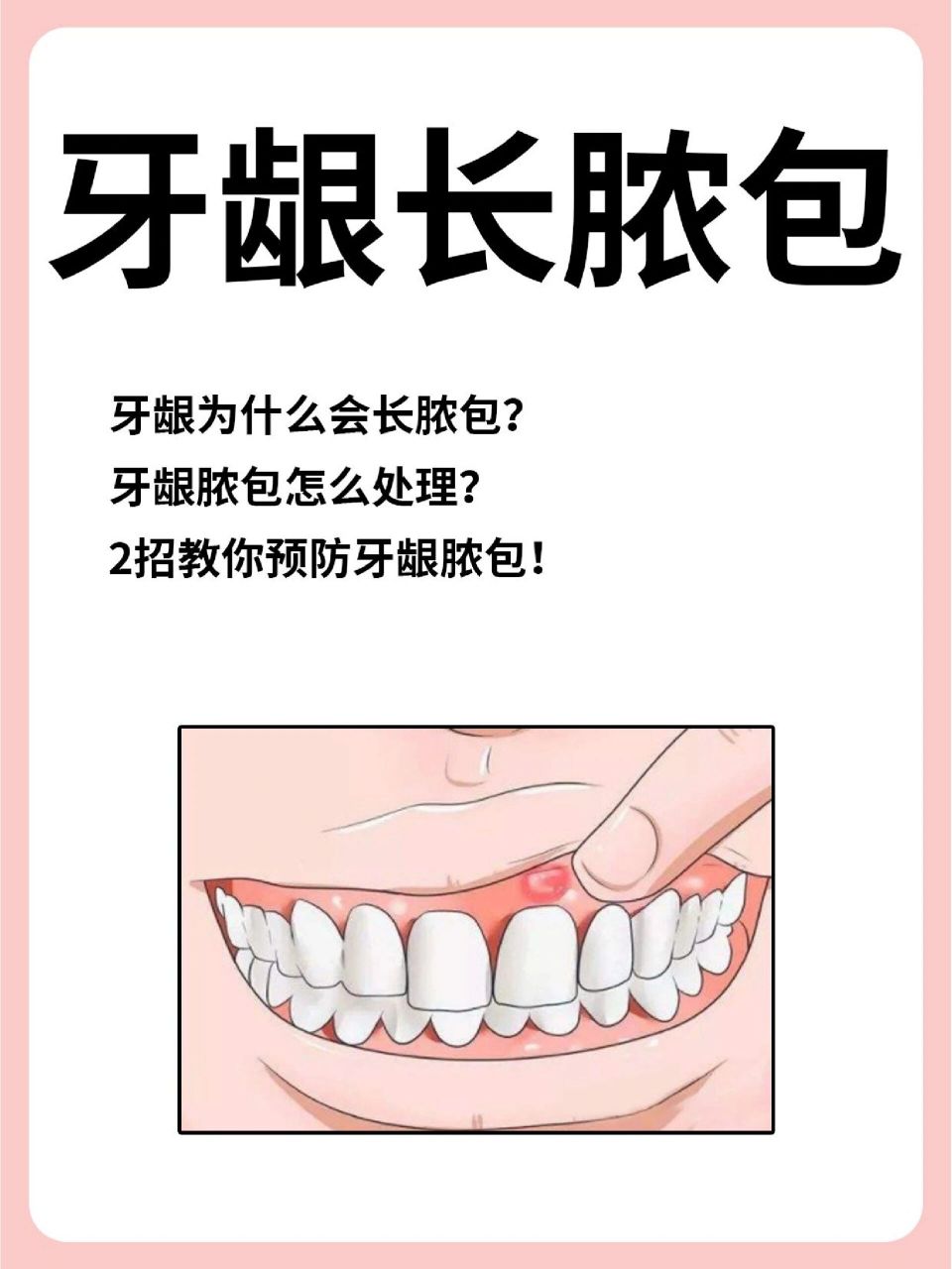牙龈上长脓包怎么回事?能自己刺破吗?