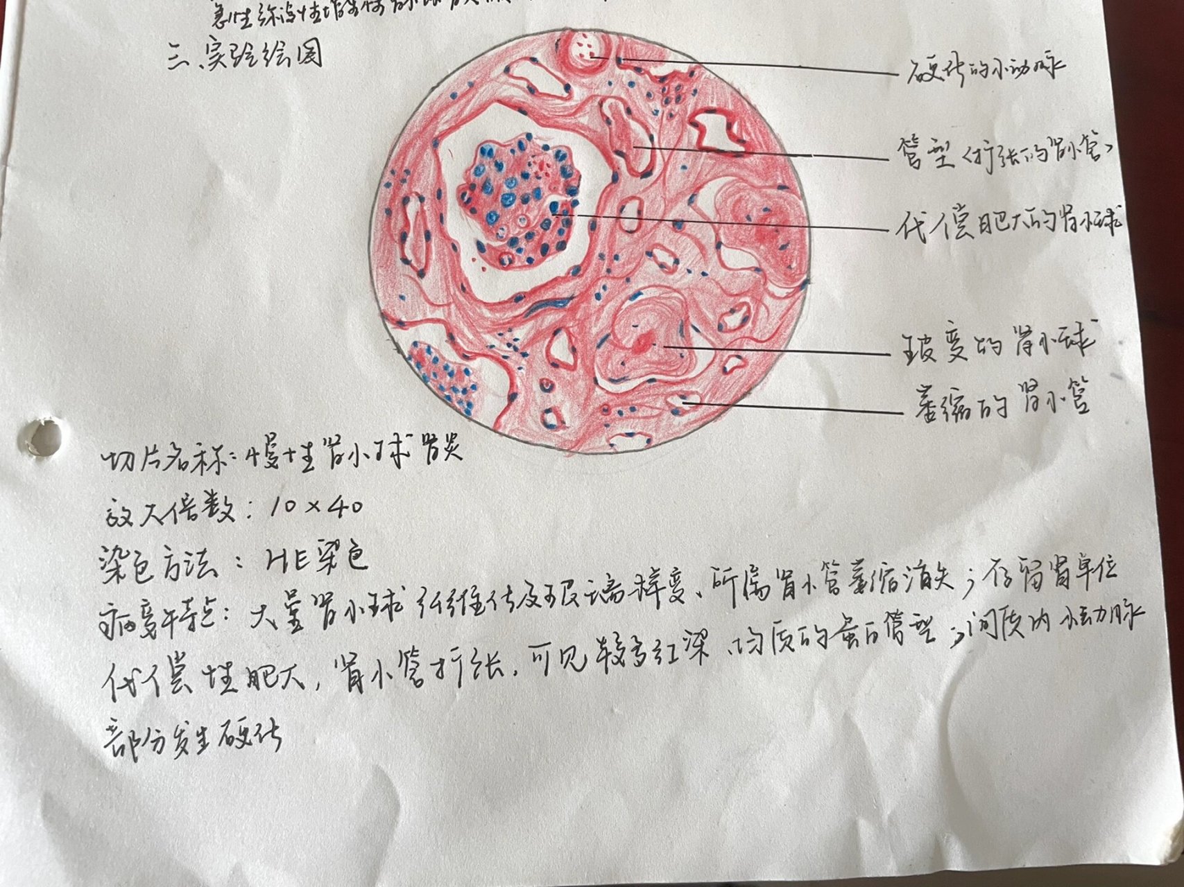 肾脓肿切片绘图图片