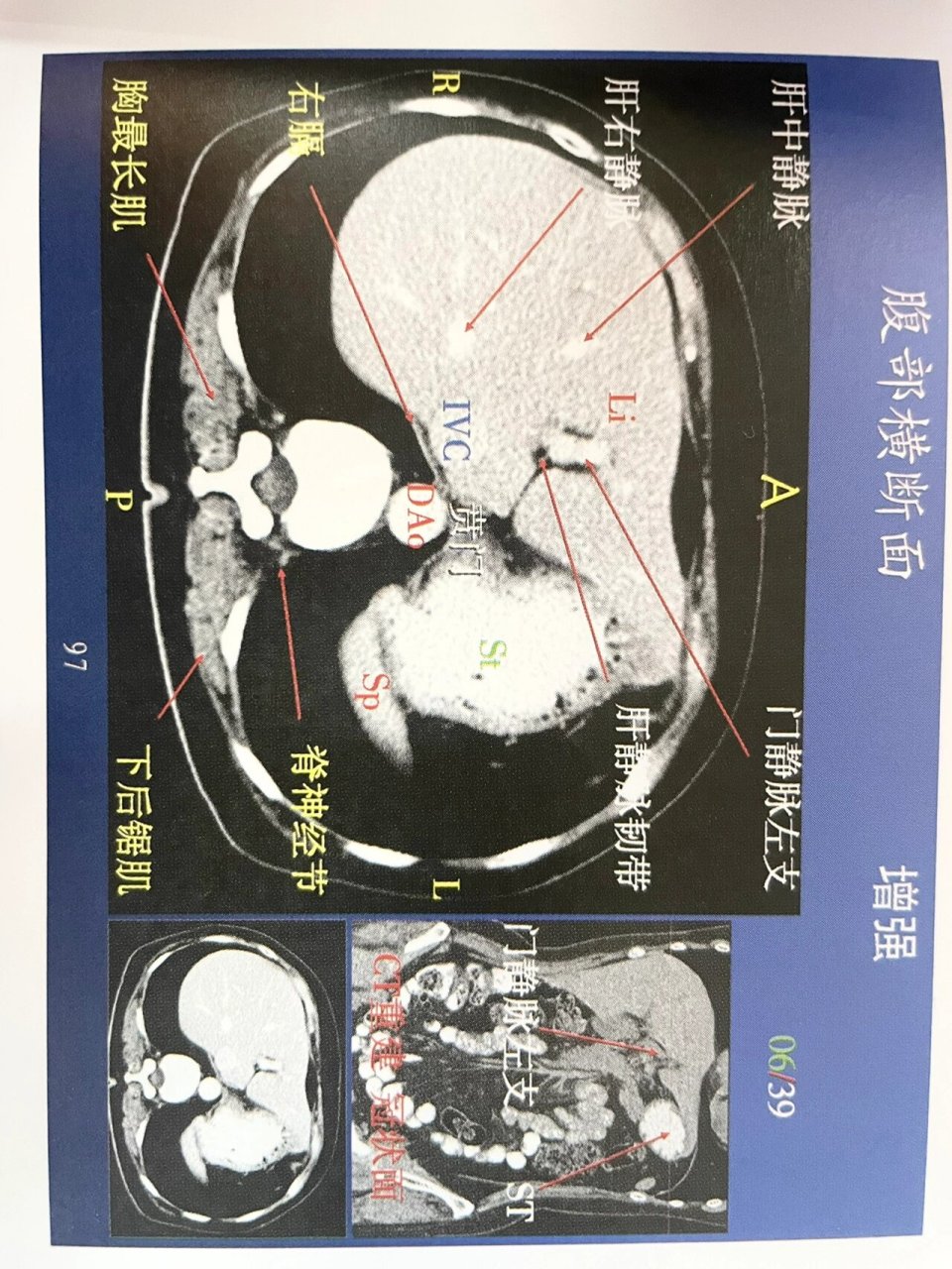 肝脏ct增强解剖!上腹部 肝脏详细横断面解剖图!