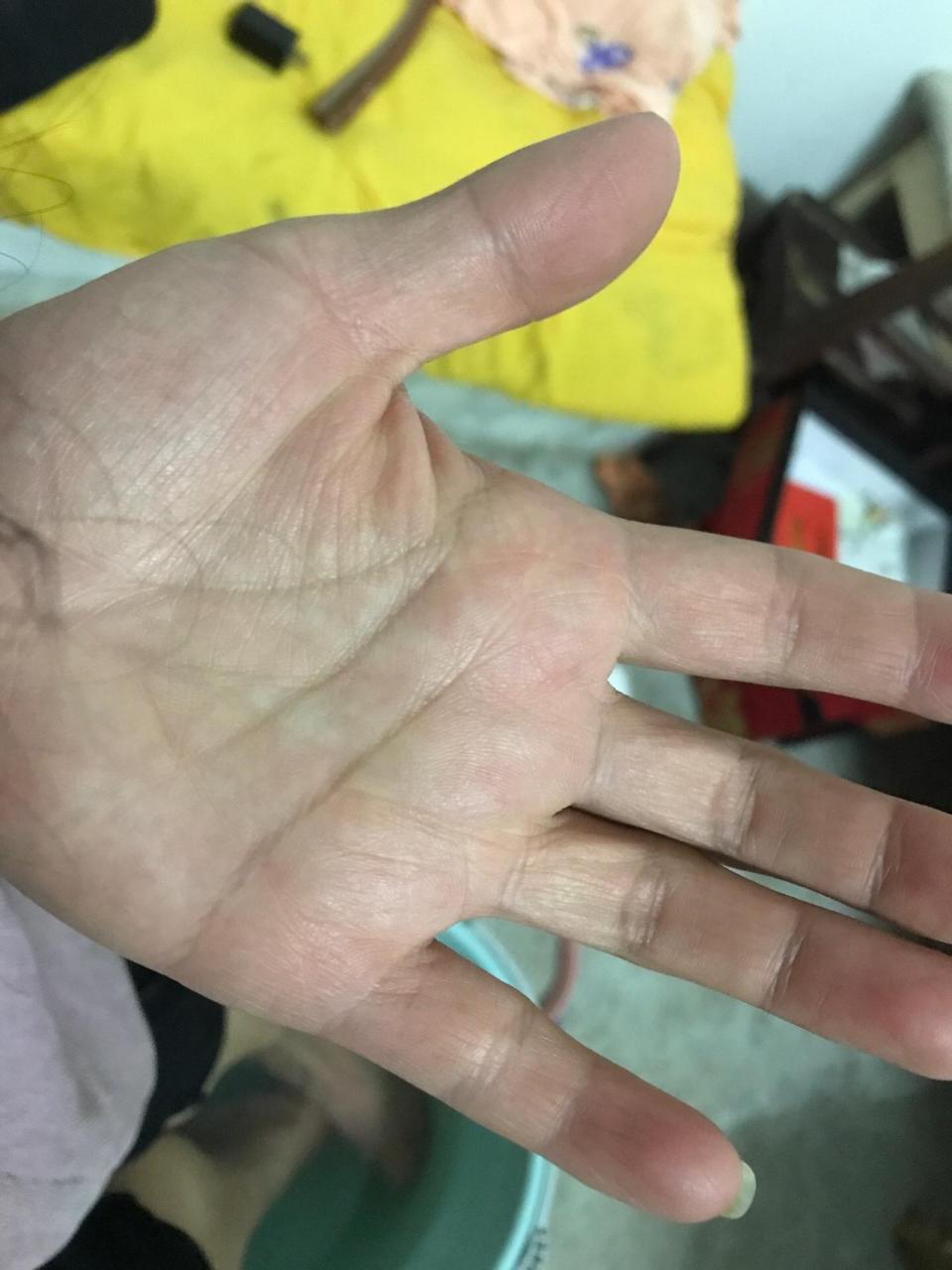 红白点点西医叫过敏,我想听听中医叫什么