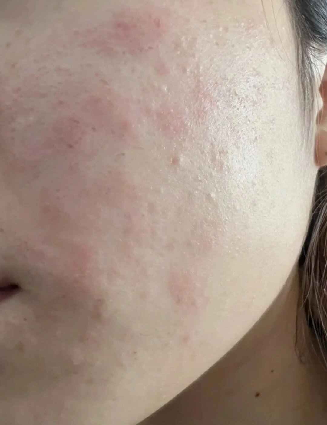 这可能是过敏/敏感肌的"信号"!赶紧自查!