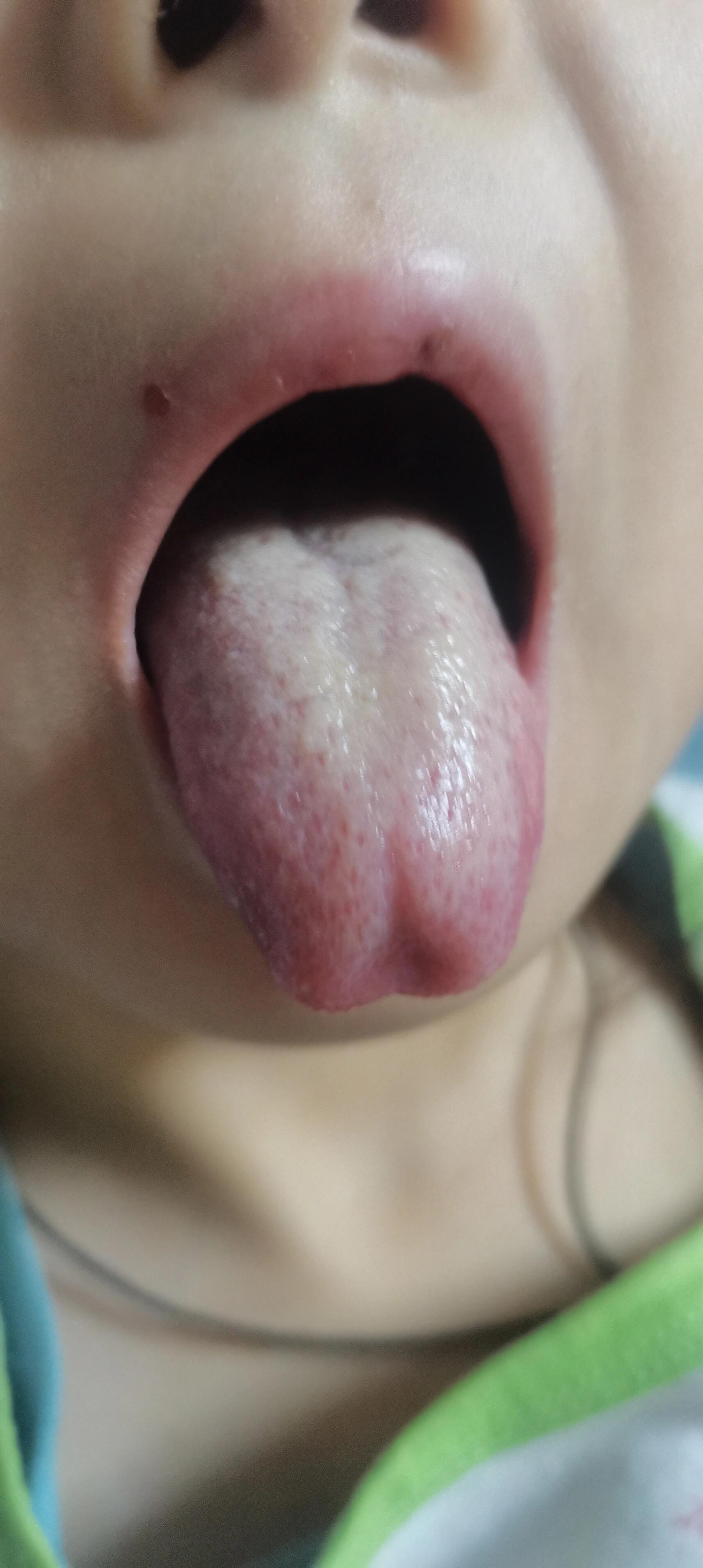 边艾灸边揉腹,多揉一会,具体方法可以小儿积食舌苔图片积食舌苔图积食