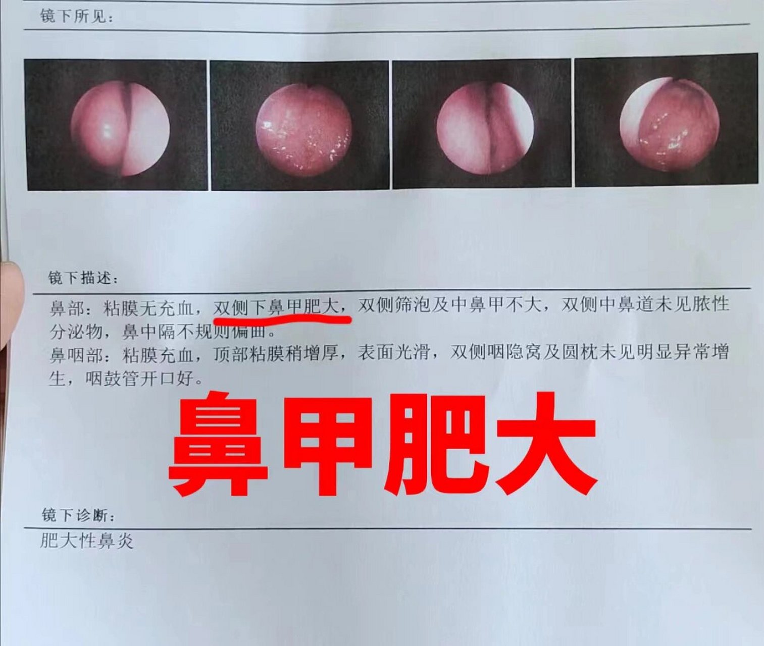 鼻甲肥大,常见表现有5种,尤其第三种!