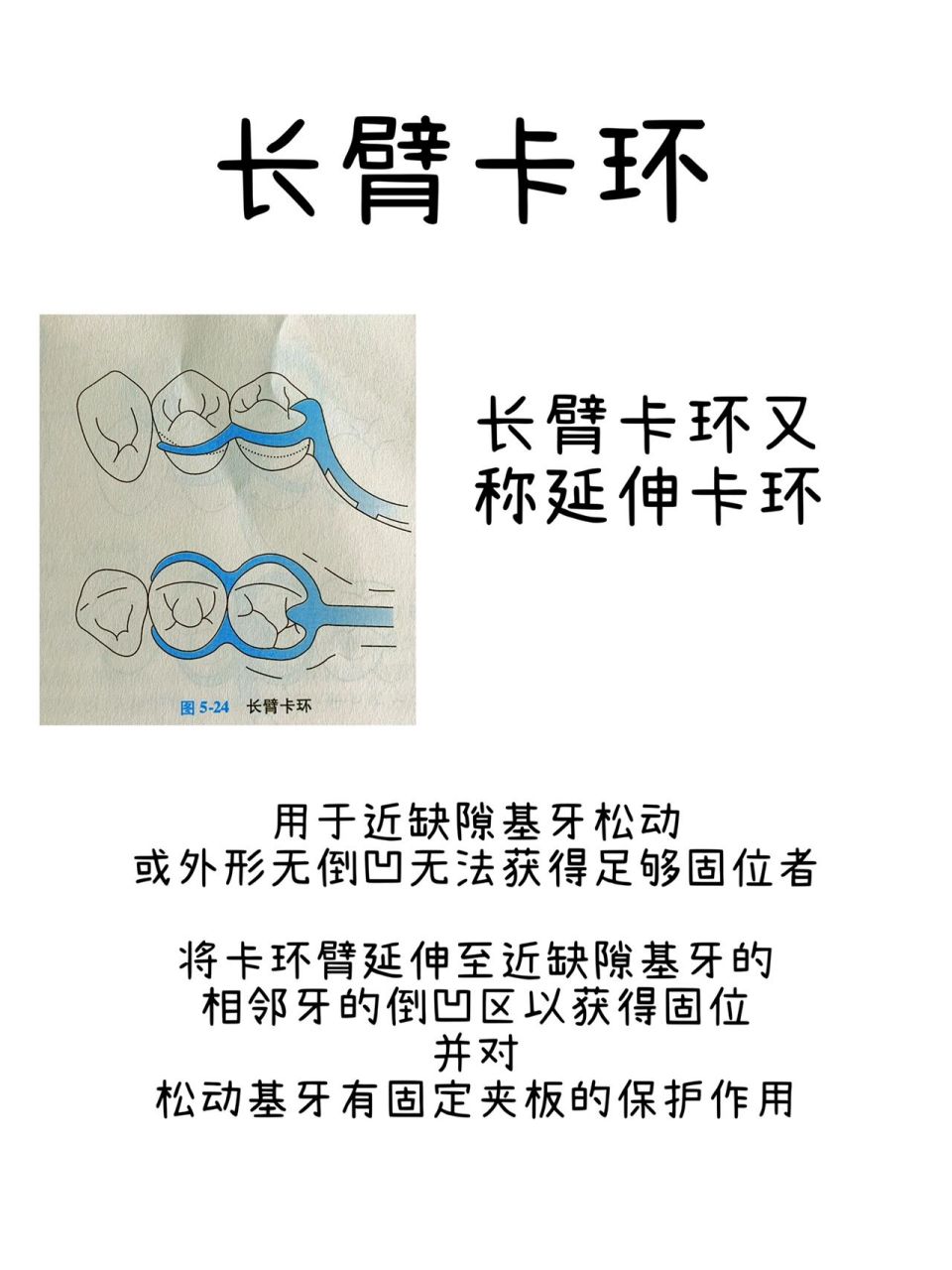 根据卡环臂数目分类:单臂卡环,双臂卡环和三臂卡环(比较