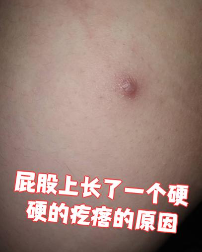 屁股上长了一个硬硬的疙瘩的原因