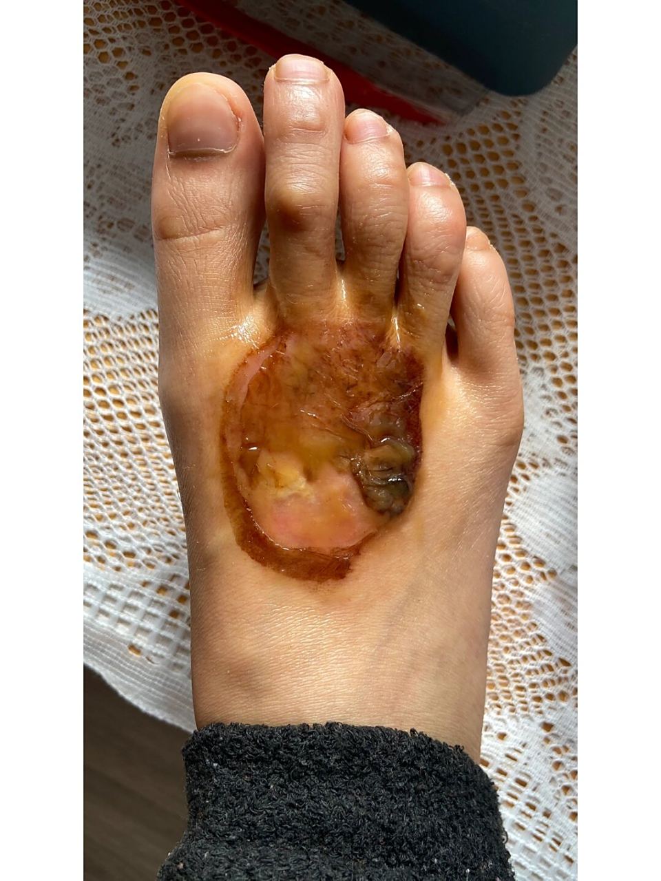 今天是烫伤的第24天,今天的脚部状况如图四,刚开始要结痂的第二天