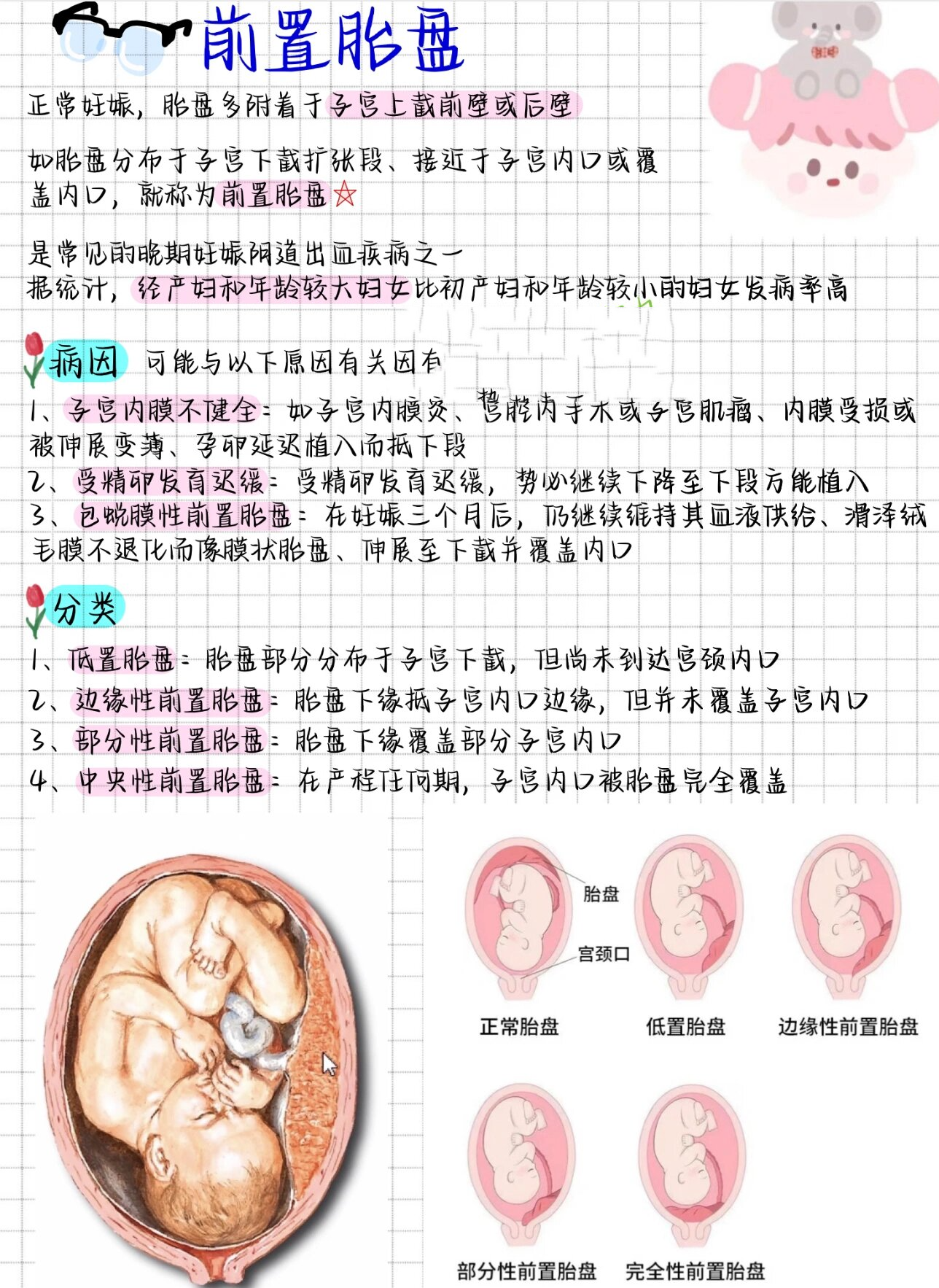 前置胎盘