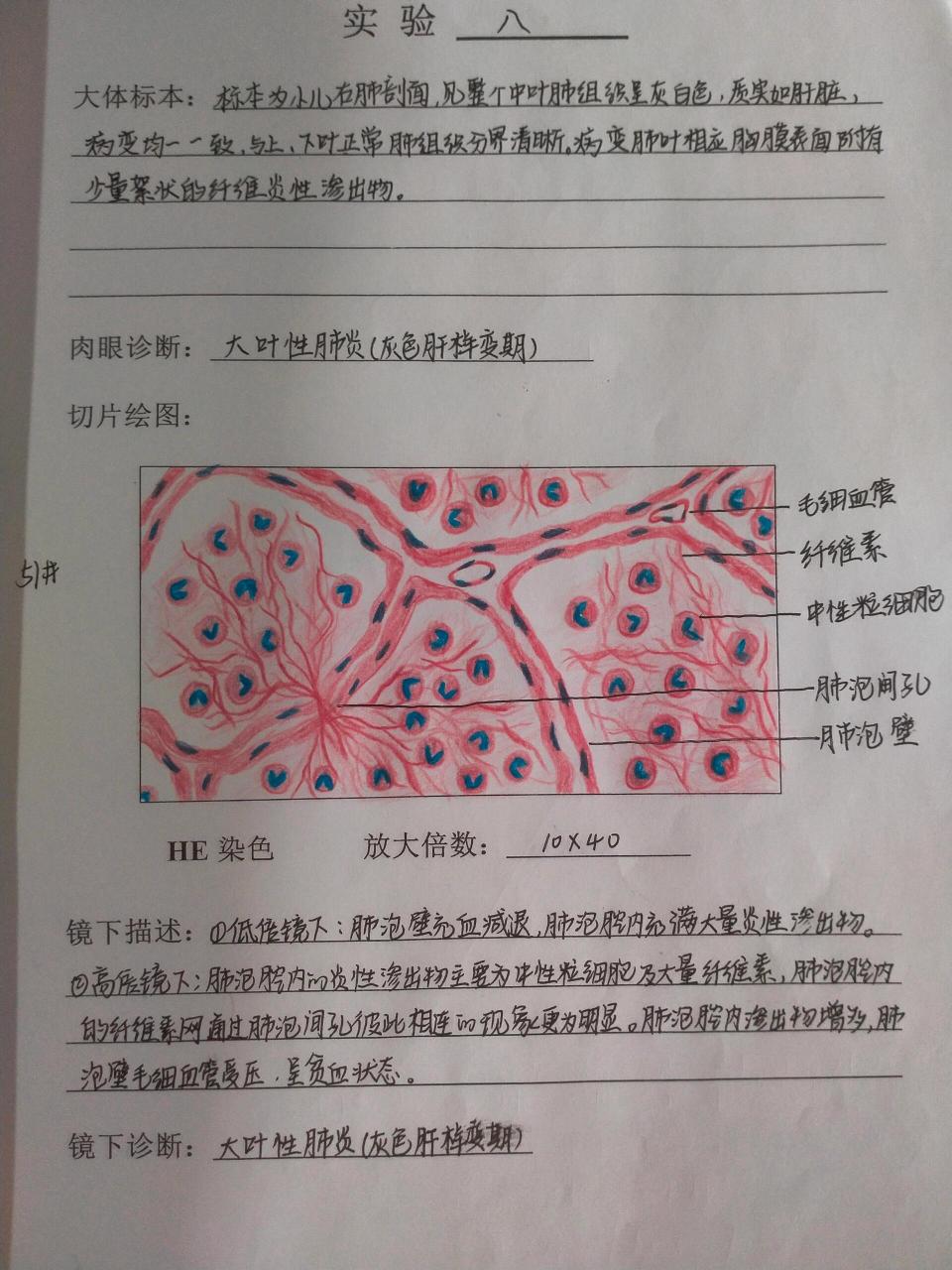 大叶性肺炎灰色肝样变期红蓝铅笔绘图 大叶性肺炎灰色肝样变期,红蓝