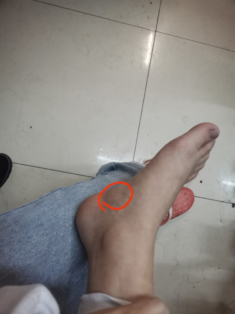 脚足弓内侧肿起 这是怎么了,好久了,姐妹可以帮我看看怎么能消下去?
