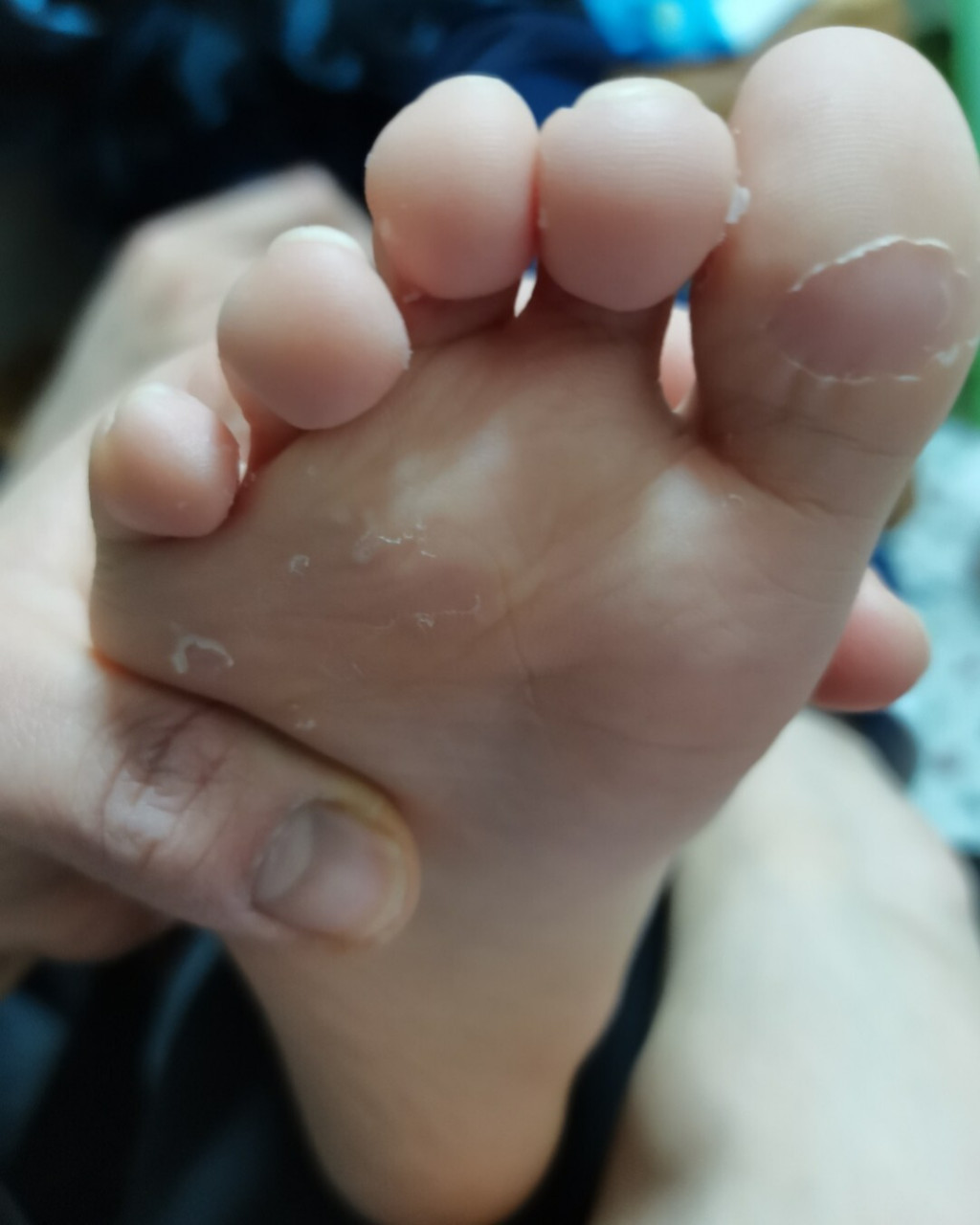 989898 求好办法我自己一直有脚气