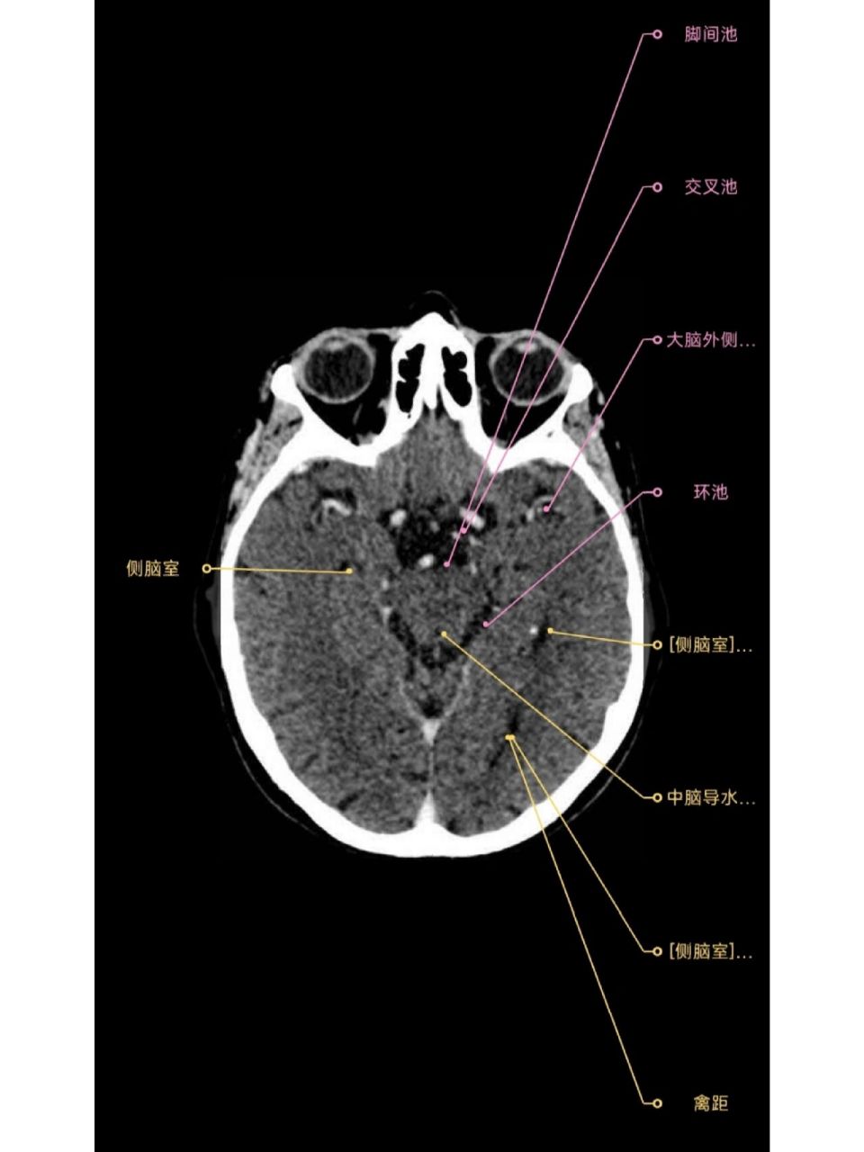 脑池 环池,脚间池,交叉池,外侧窝池