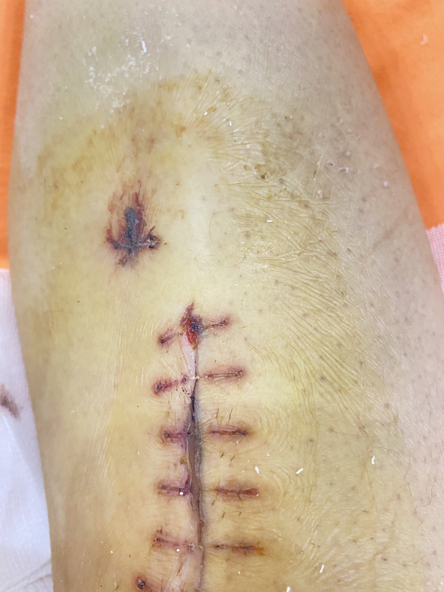 胫骨骨折术后17天,拆线后第一天