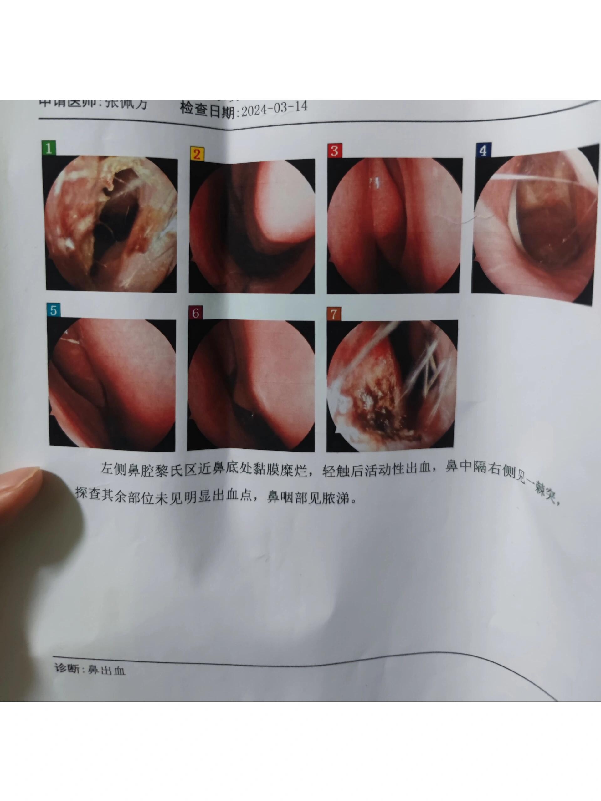 鼻黏膜难受图片